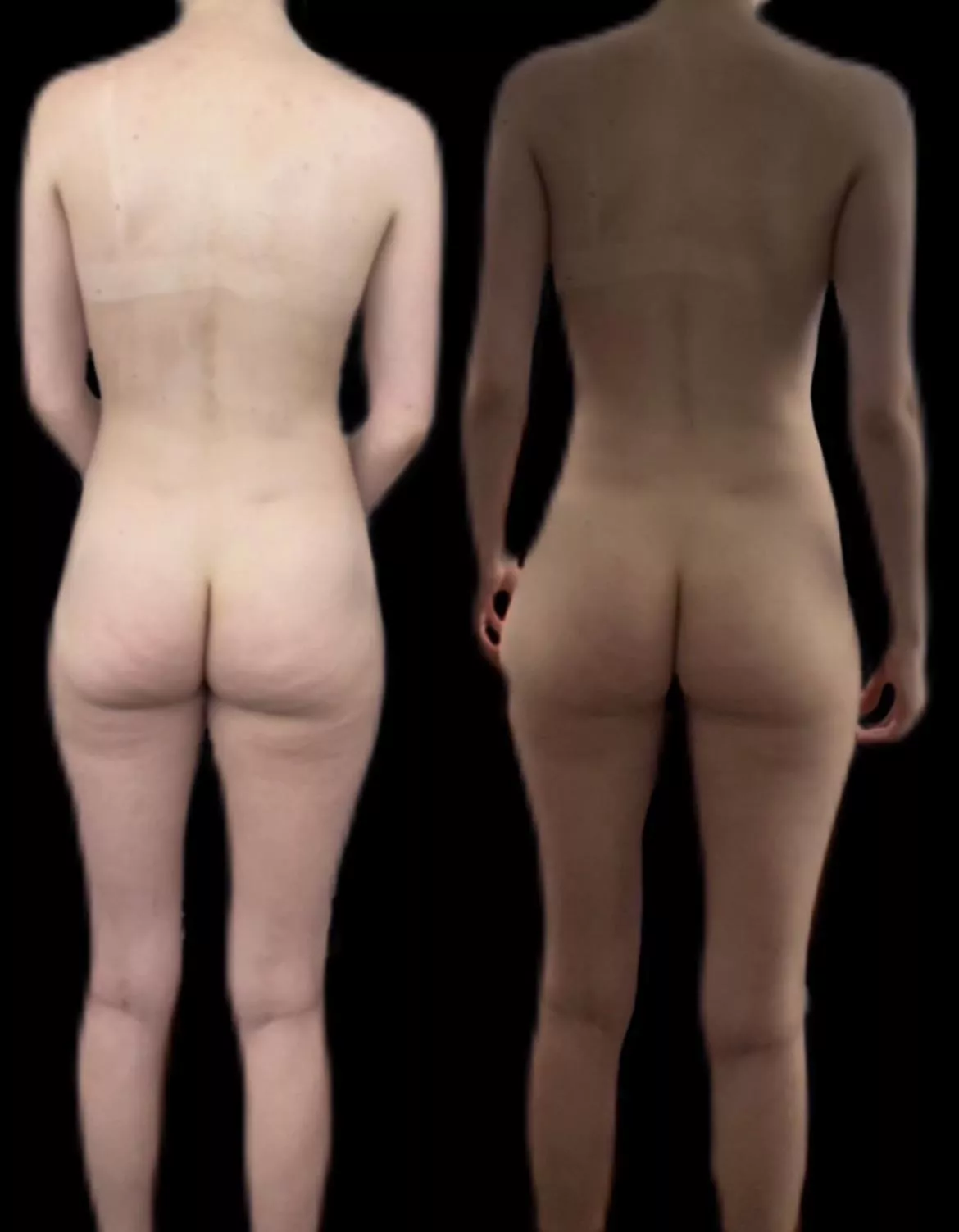 F23/5’9/138 - direct light standing naturally vs indirect light w/ slight pelvic tilt, feet farther apart & shoulders back posted by normal_person365