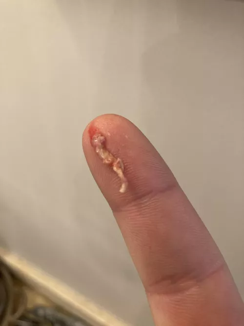 Finally got this bastard out of my ear after 3 days of festering by Content_Comparison_2
