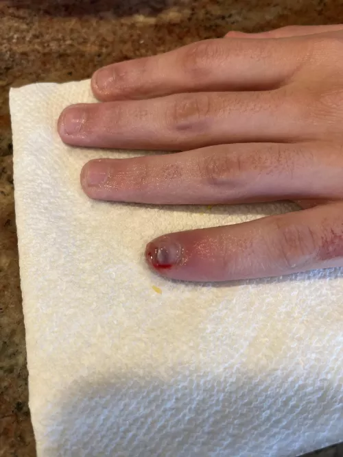 Finally got this damn infection out of my finger by Let_me_S_U_F_F_E_R