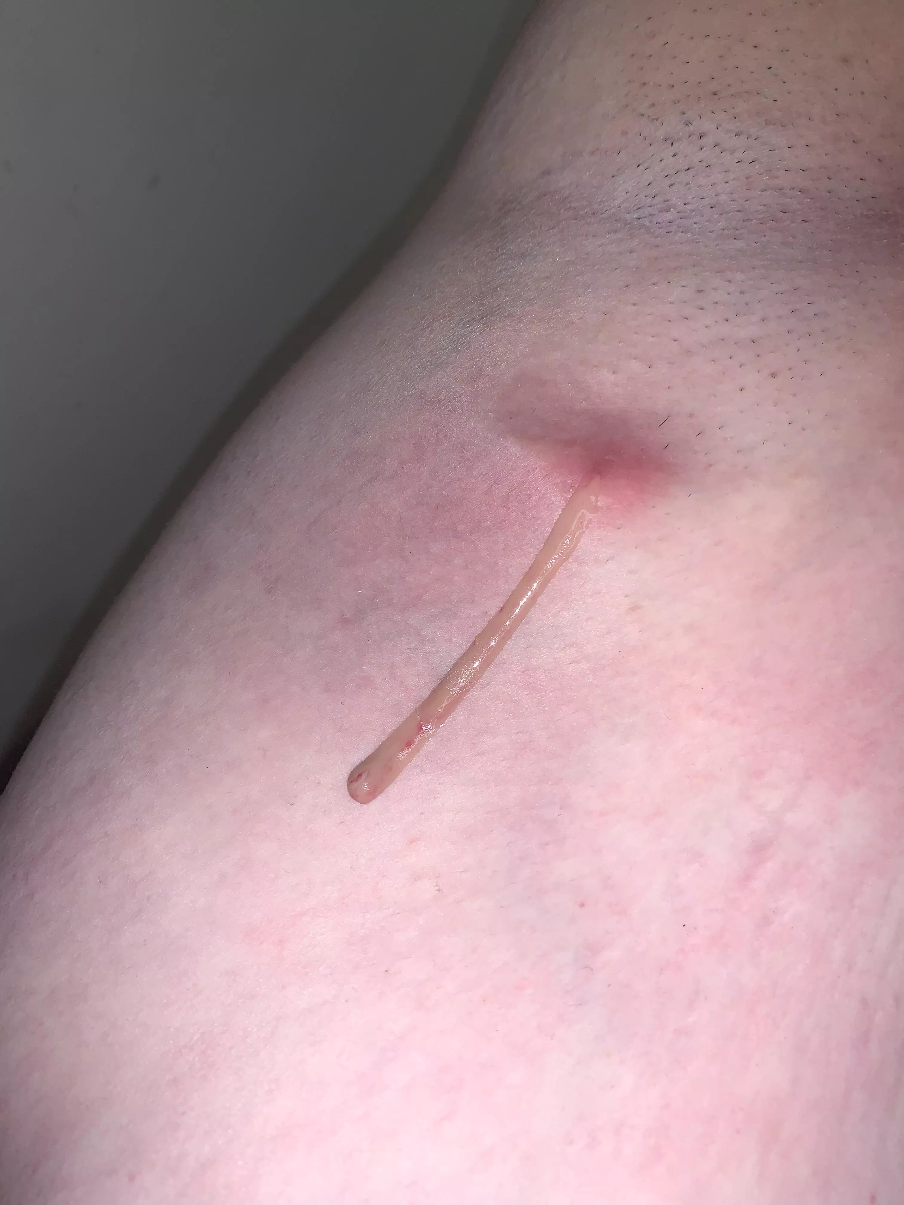 Finally some relief after four days of antibiotics posted by humanem0ti0n