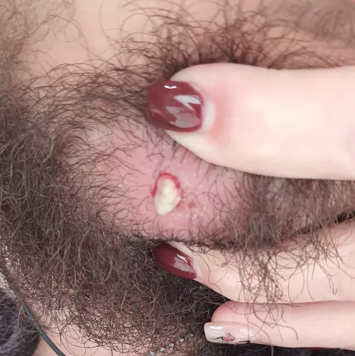First time posting! Left over of a ingrown hair pop. by WolfTheKiller1999