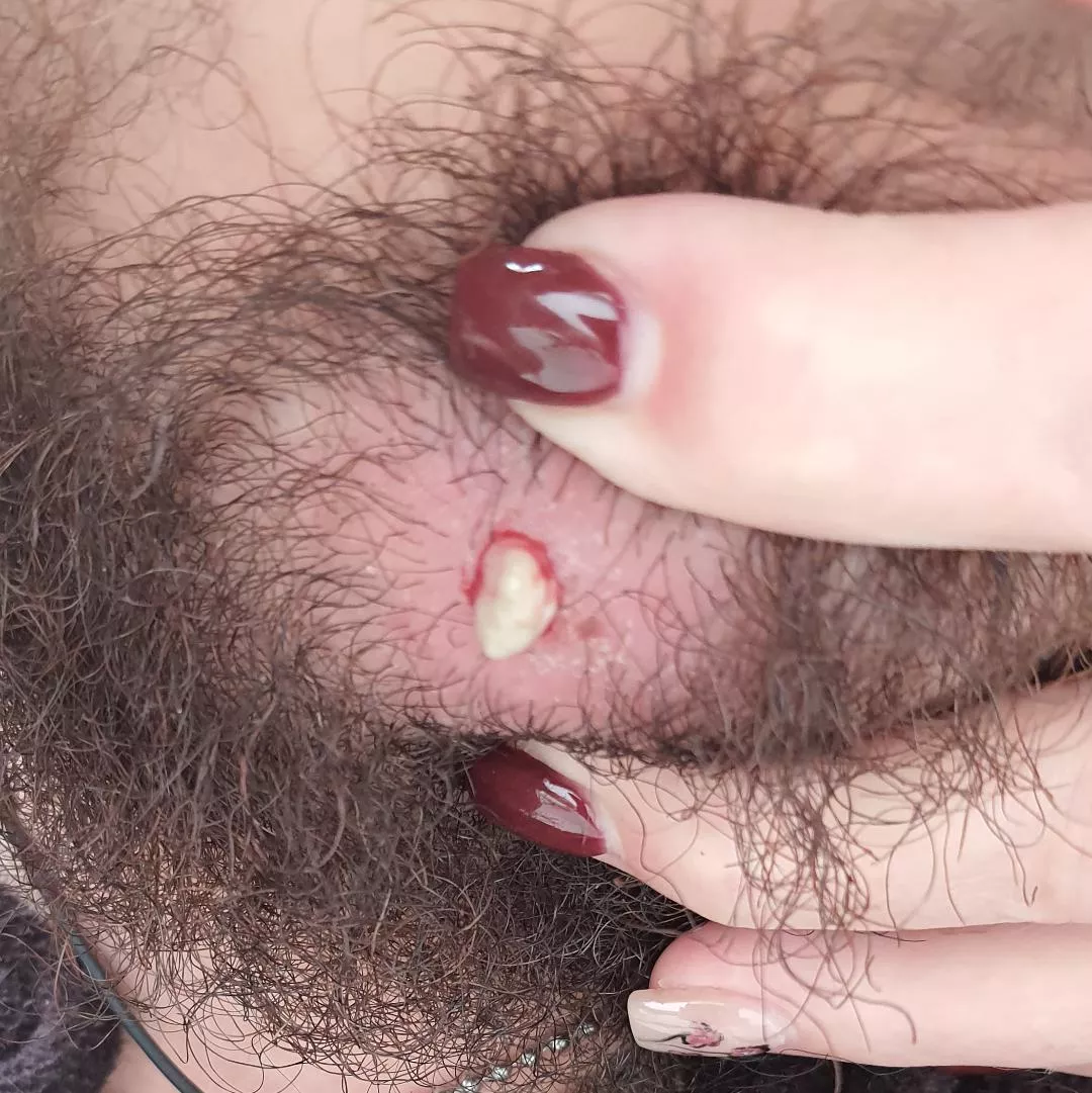 First time posting! Left over of a ingrown hair pop. posted by WolfTheKiller1999