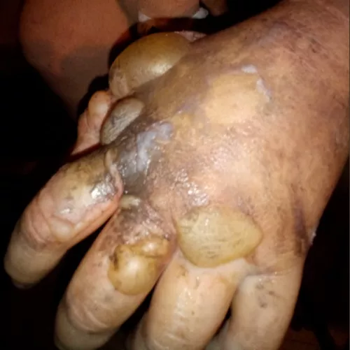 Forbidden bubbles. (grease fire burns) by Rxckless92