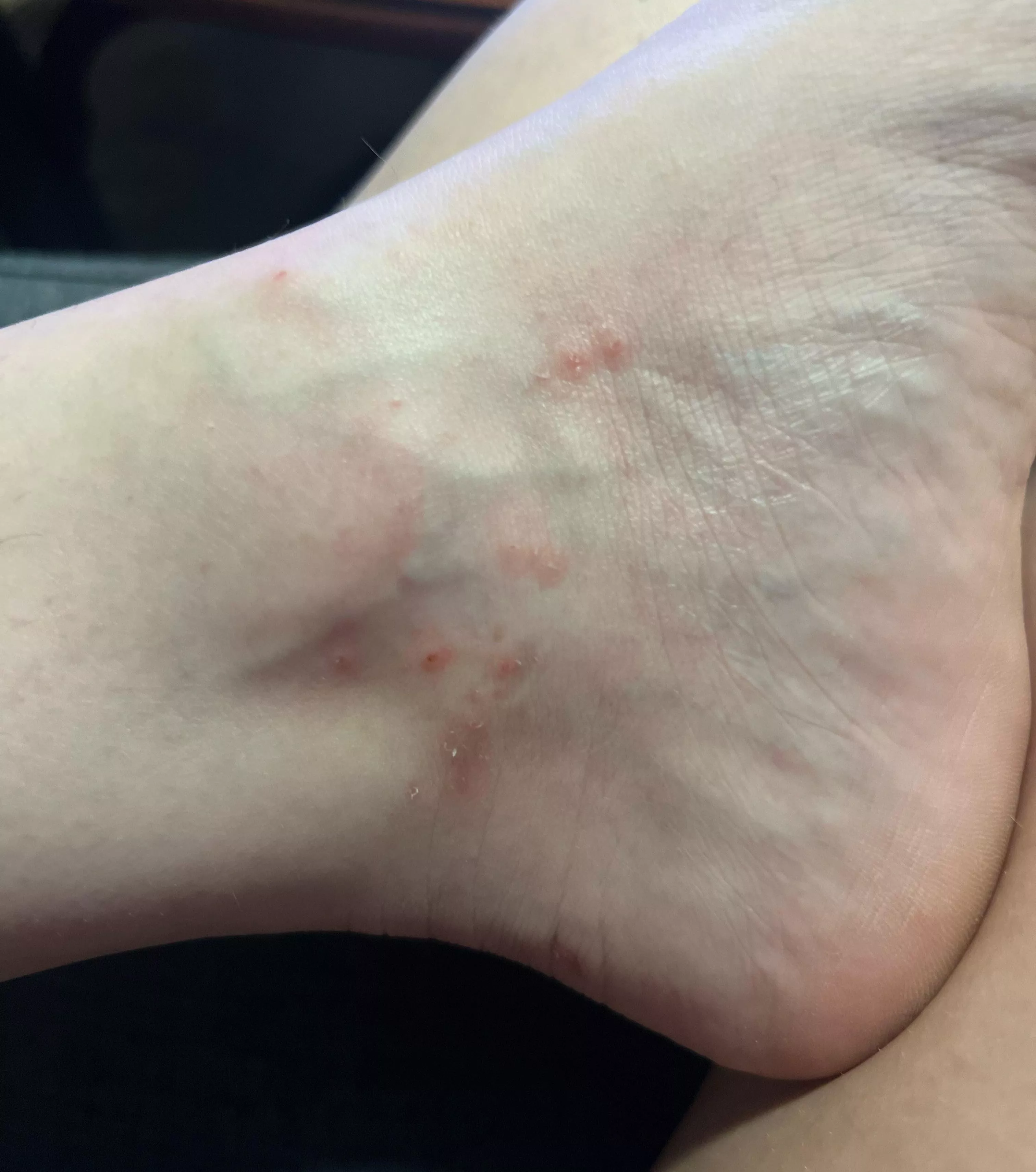 Forbidden Dyshidrotic Eczema posted by dykeryot42