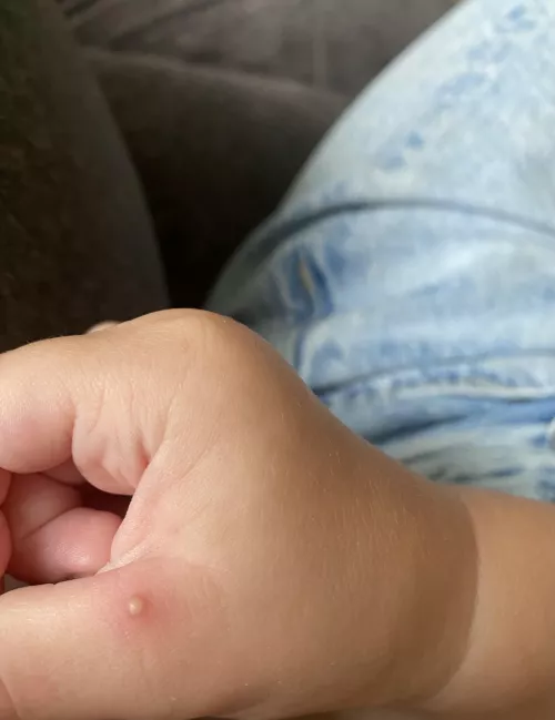 forbidden fire ant pop on my toddlers thumb 🥲 by trradgedyy