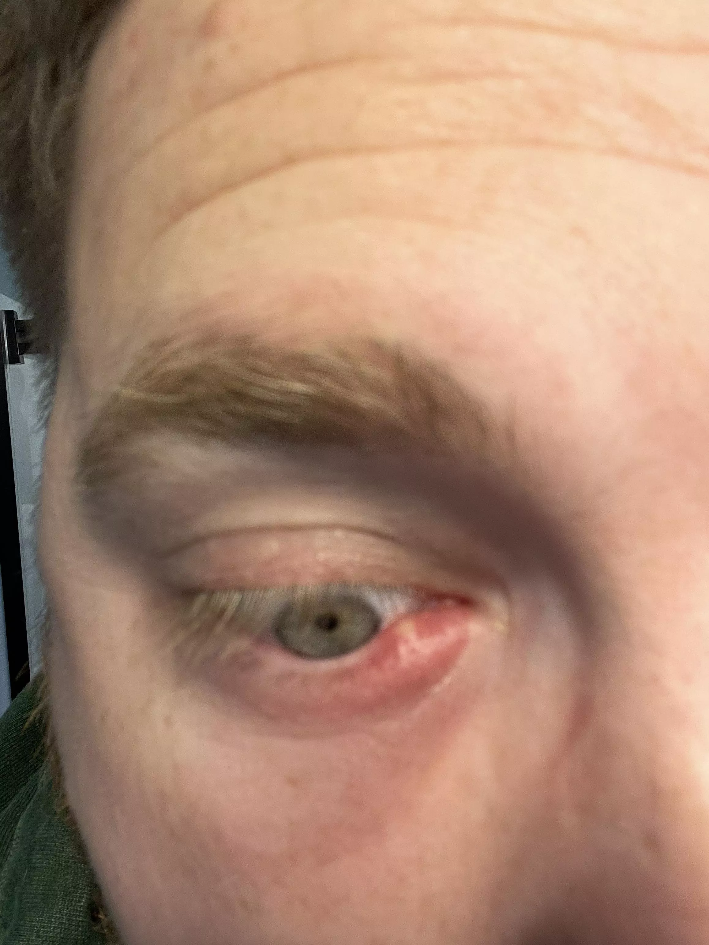 Forbidden Pop, been using a hot compress, hope this pops soon… posted by jrryrchrdsn