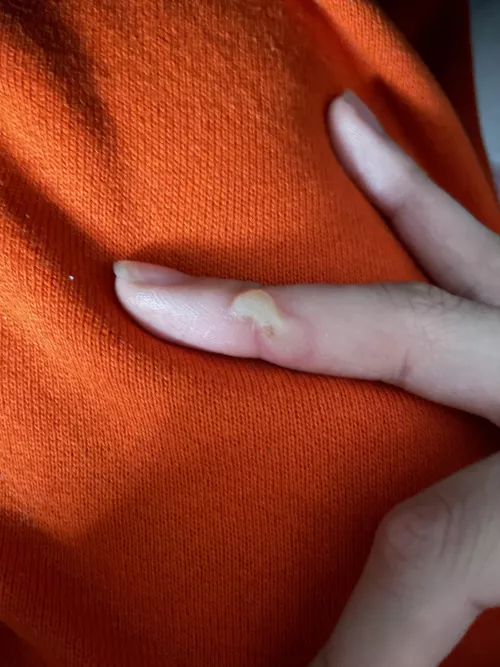 Forbidden pop :( burnt myself yesterday grabbing a utensil off a hot pan by spiritdashahri