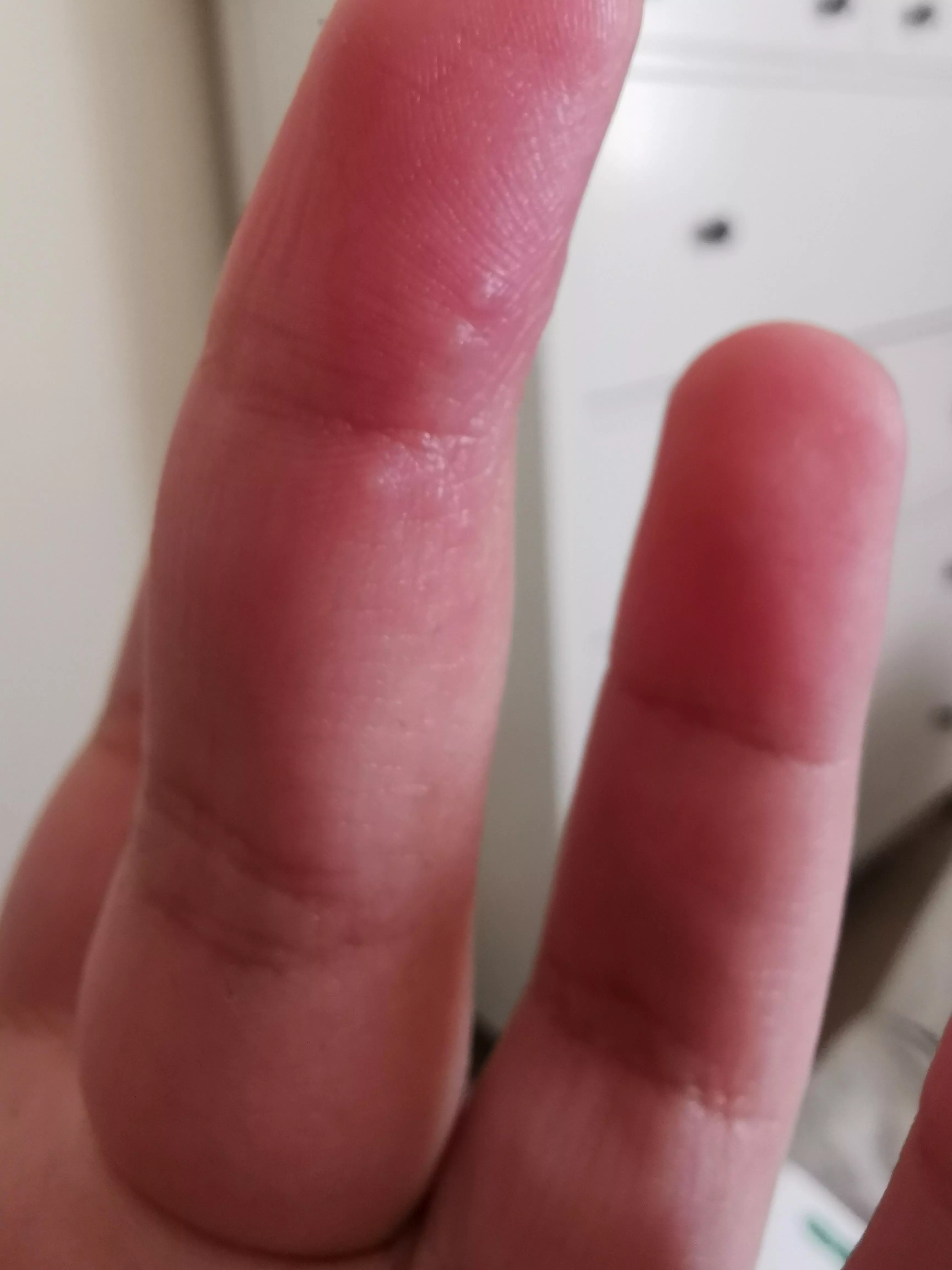 Forbidden pop, dyshidrotic eczema. posted by Constant-Ad4761