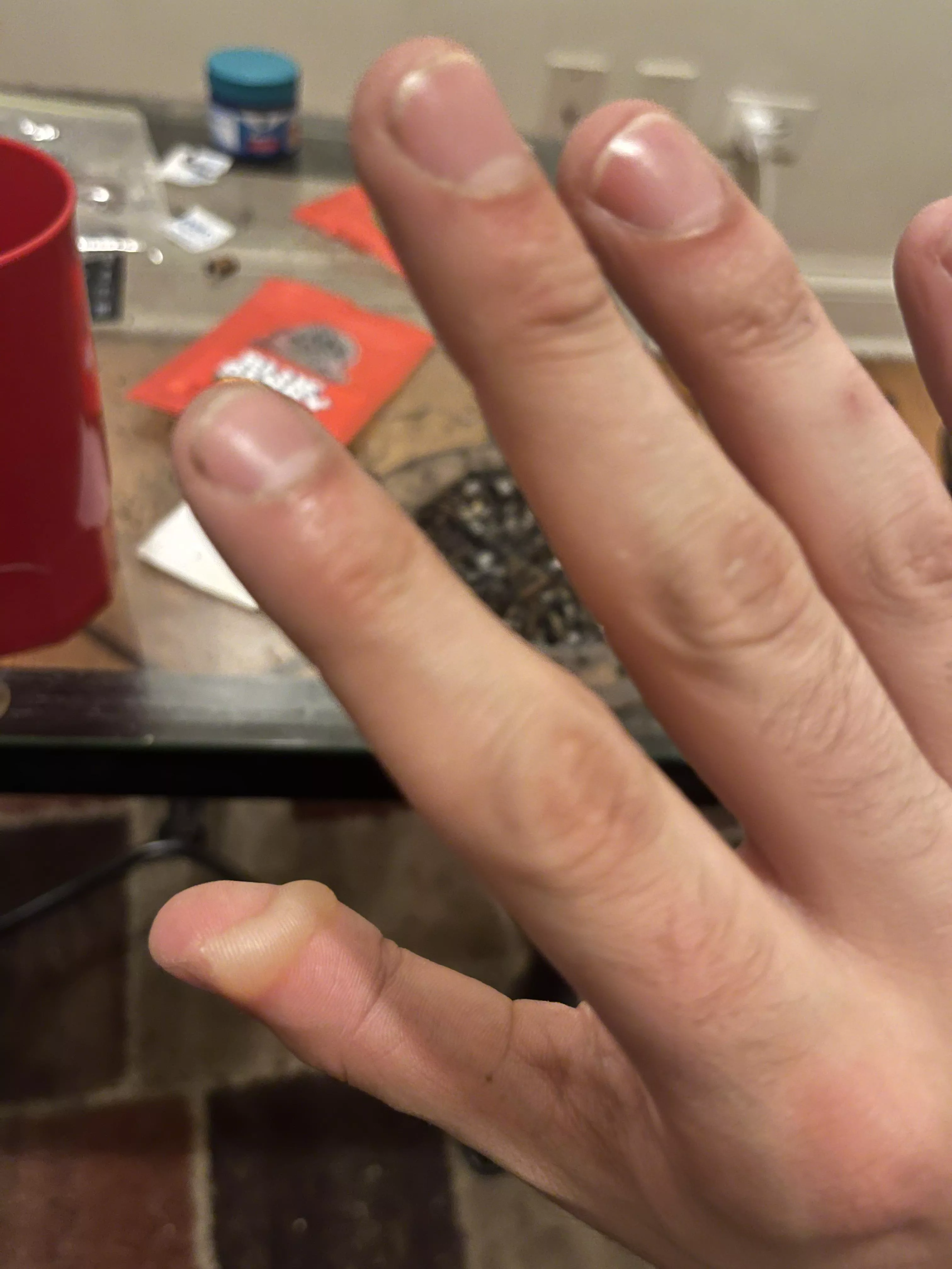 Forbidden pop: I burnt thumb at work yesterday. posted by ShadyBoots11