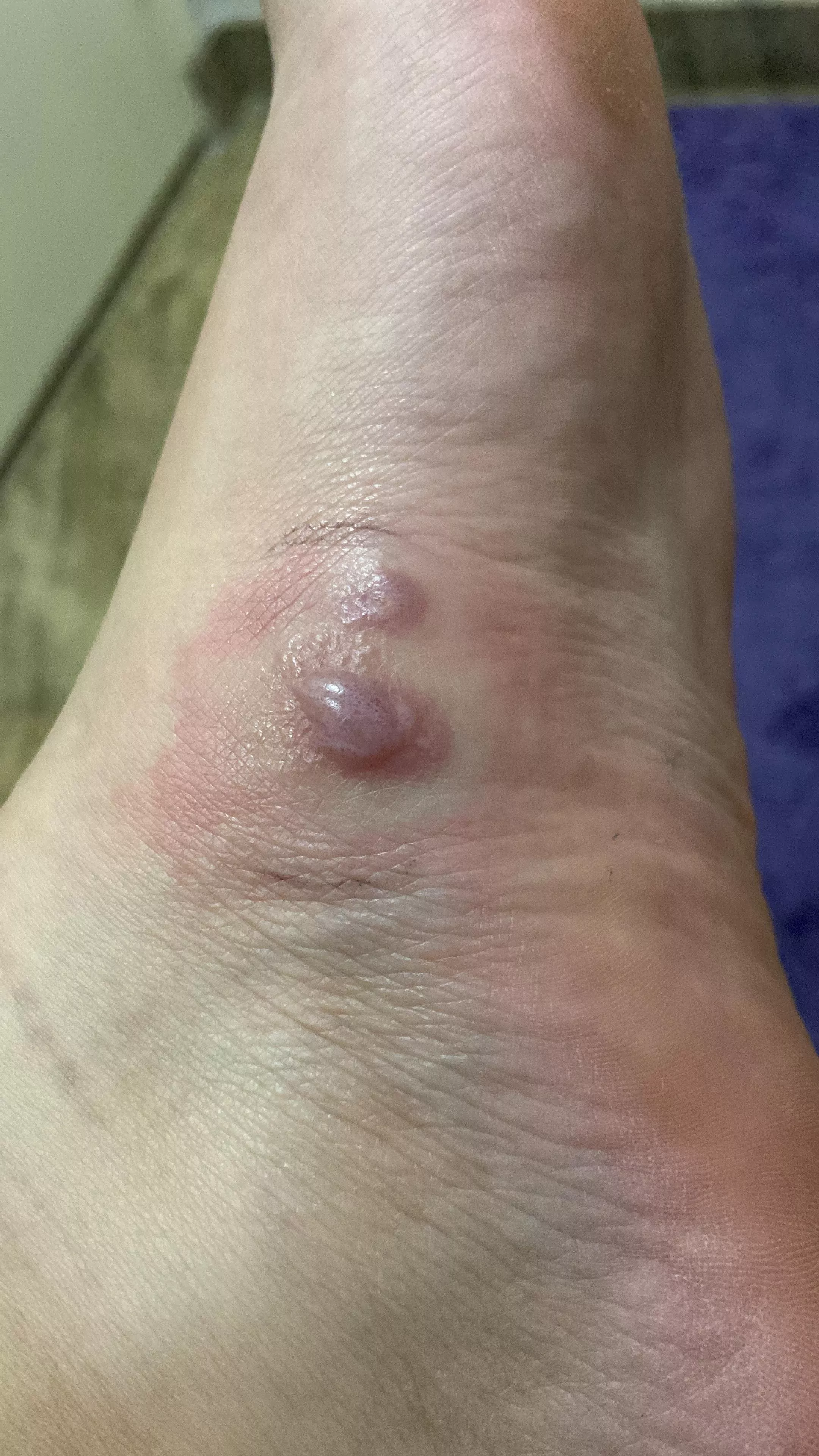 Forbidden pop on my foot. Already went to the doc. More on the comments posted by theresagray17