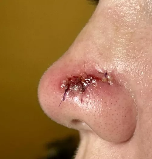 Forbidden pops. Had a reaction to the sutures! by Oapy