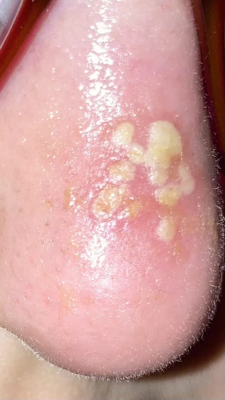 Forbidden pops on my nose posted by theindiekitten