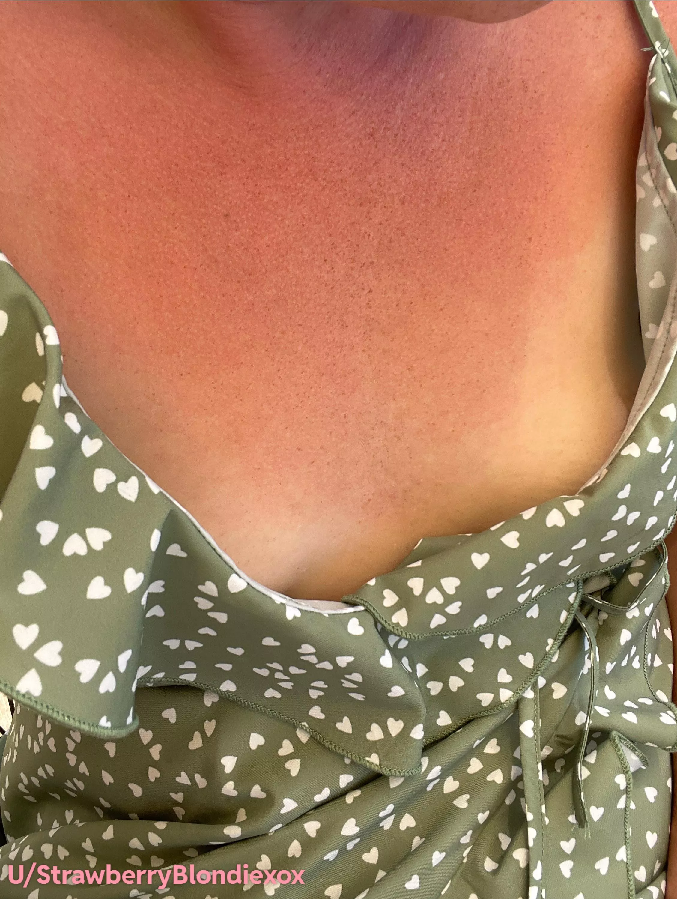 Freckles & Tan lines! 😘 posted by StrawberryBlondiexox