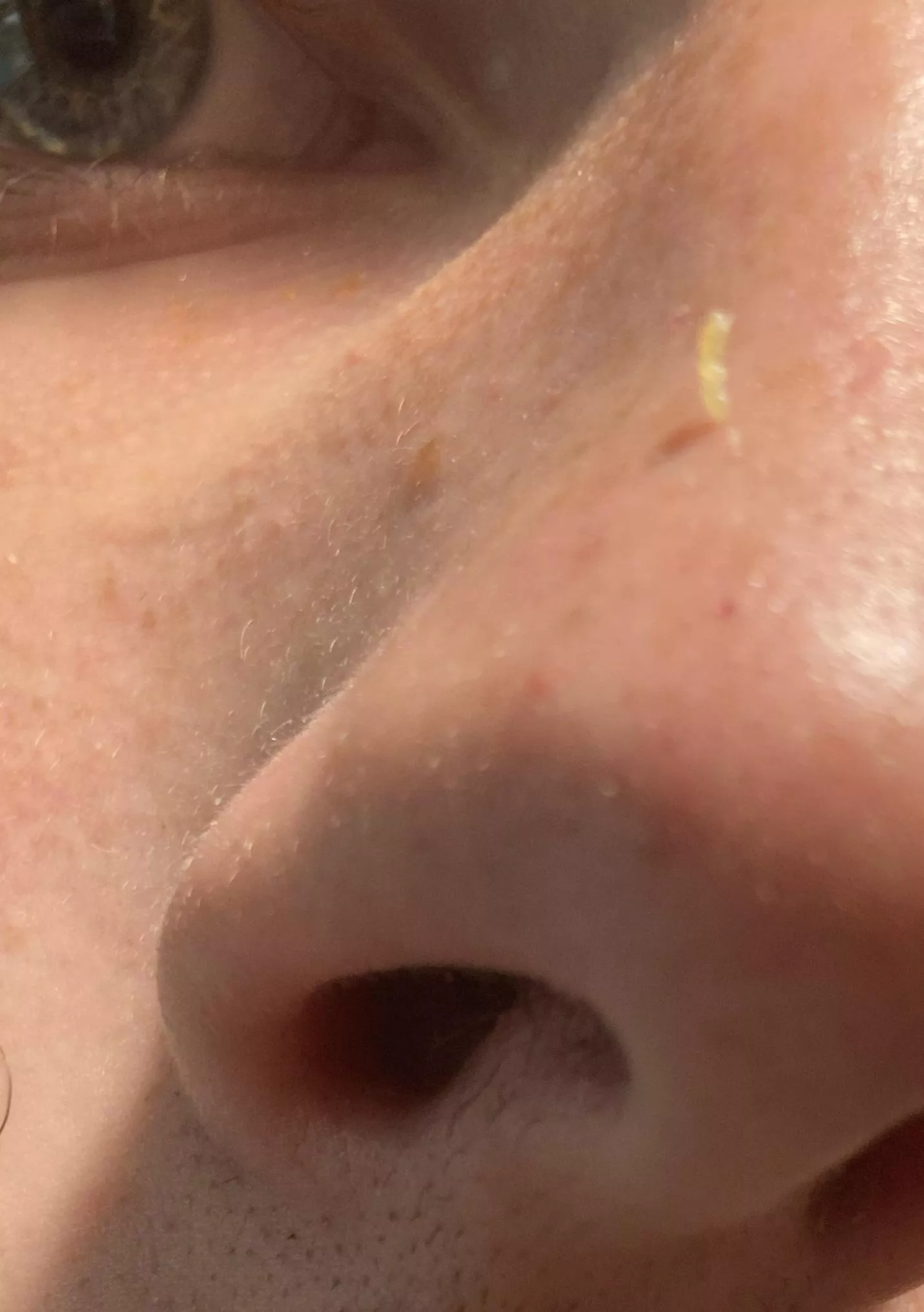 From one blackhead on my nose. posted by ClickBeam
