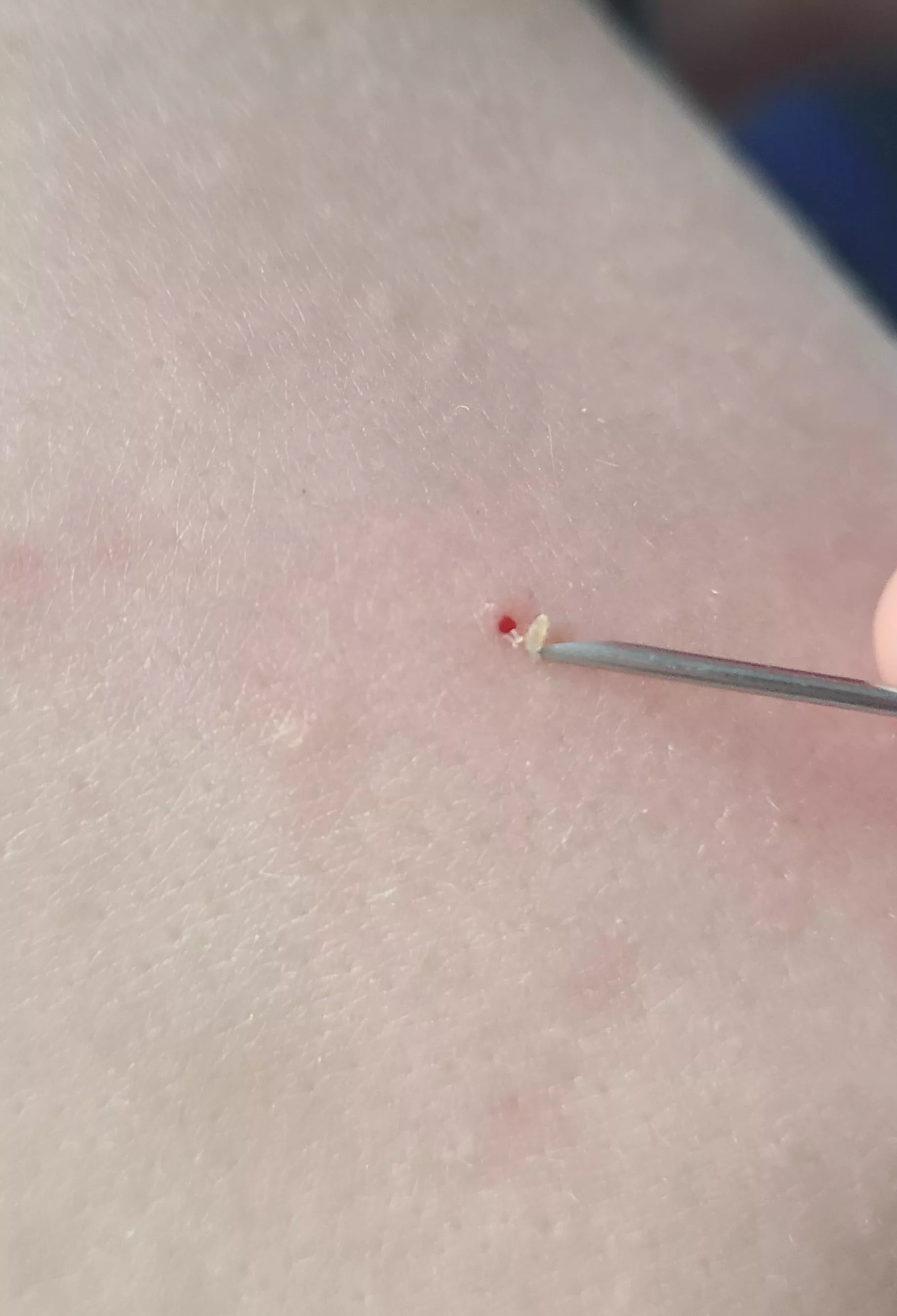 Giant hole left in my bfs shoulder from this blackhead posted by wolfden2016
