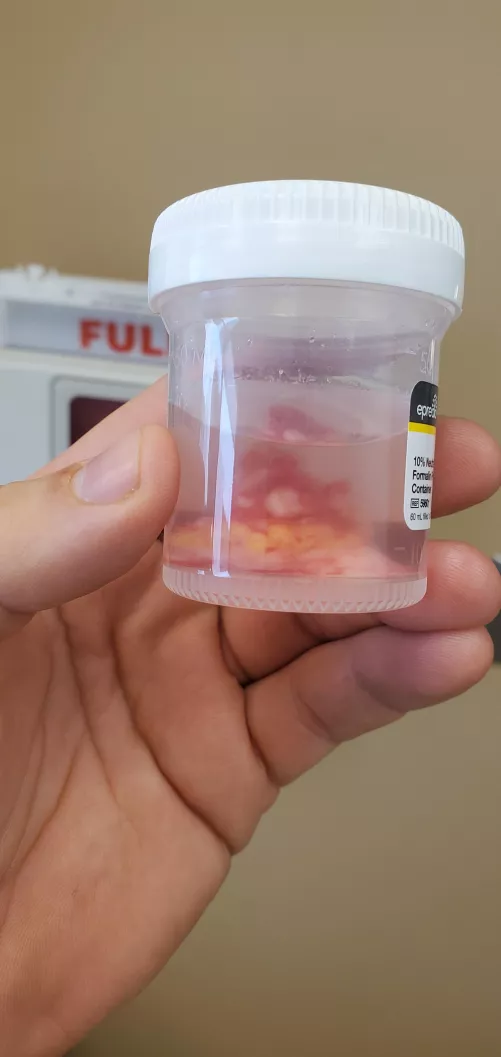 Goodbye cyst. I won't be missing you. by tiberiusgv