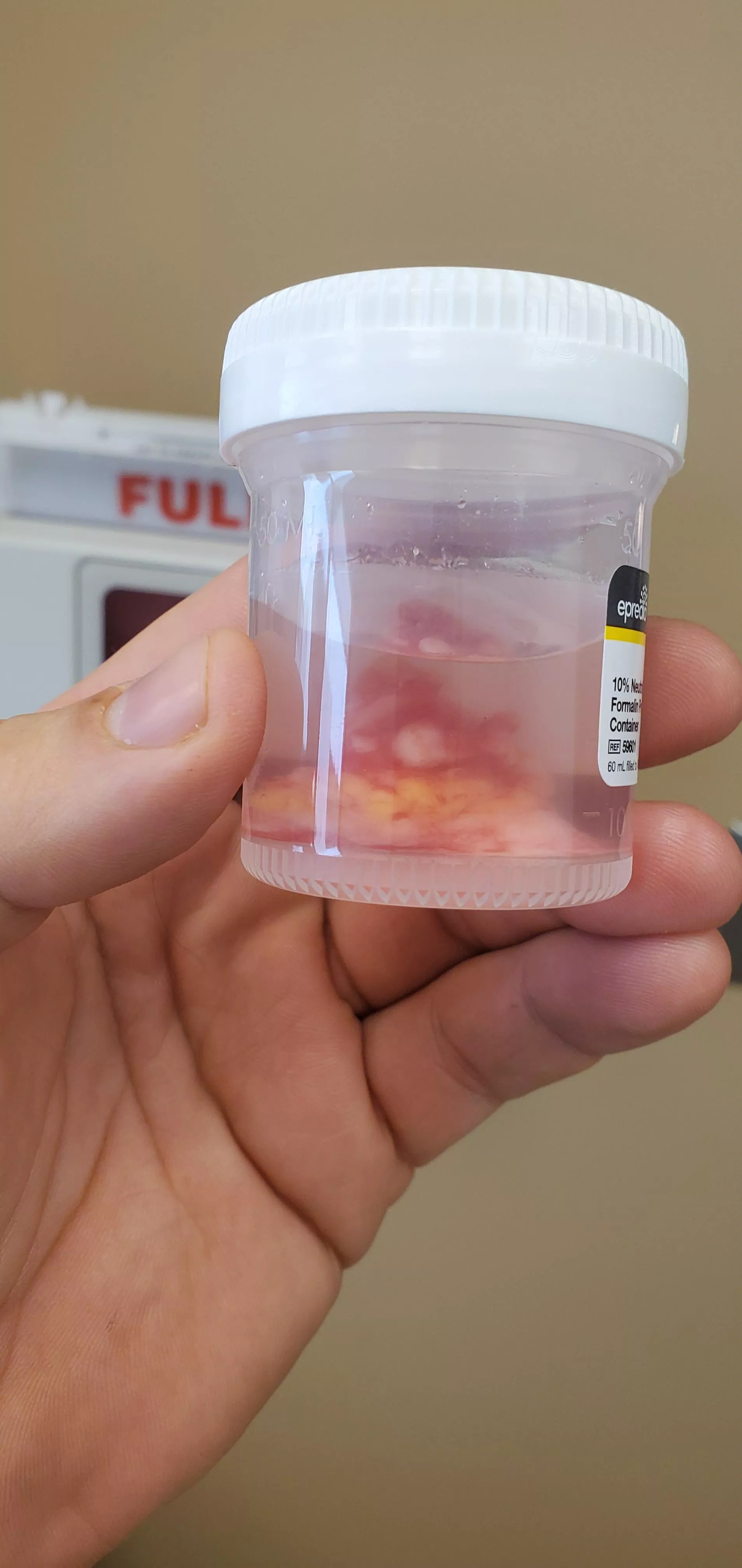 Goodbye cyst. I won't be missing you. posted by tiberiusgv