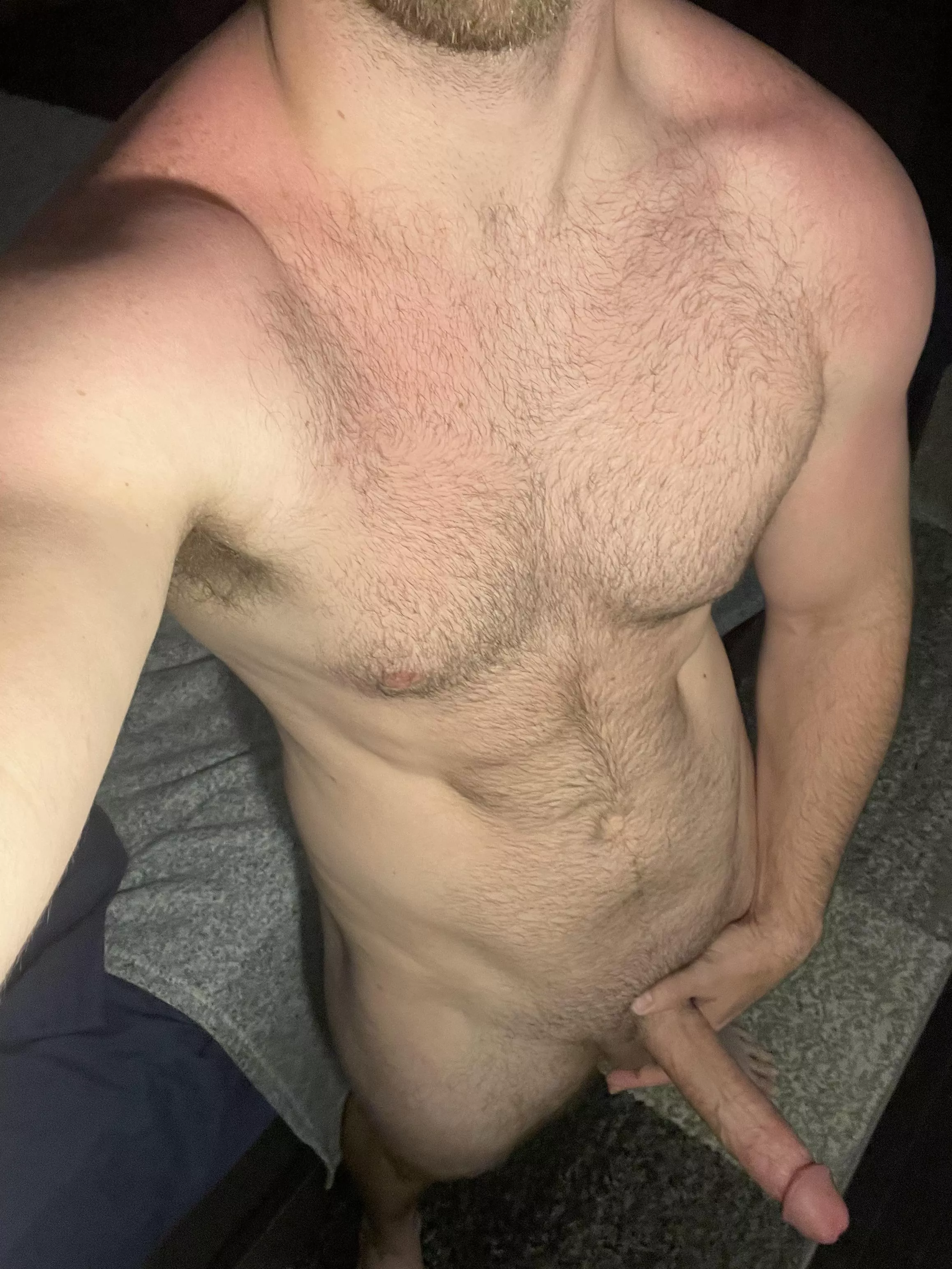 Got a bit sunburned this weekend posted by swizzledick_