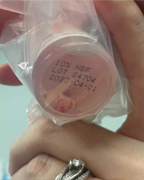 got a pilar cyst removed from my head today, here it is! it looks like an eyeball lol so interesting by Adorable_Ad4604