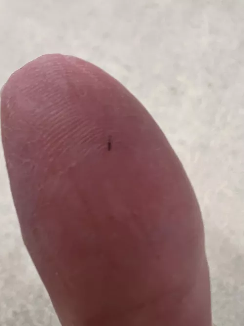 Got a sliver; no tweezers = torture! by SurvivingComplexPTSD