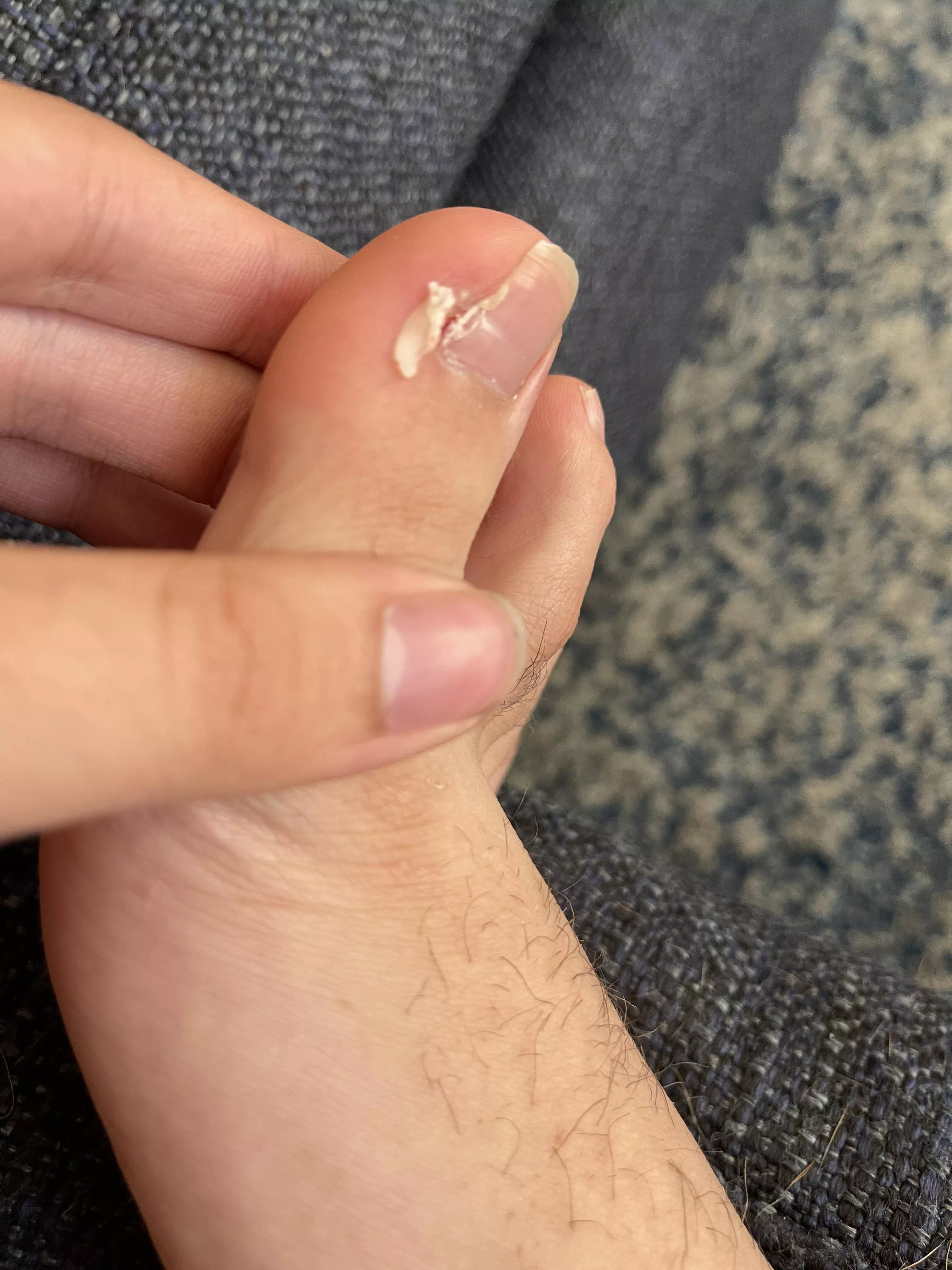 Got ingrown removed a few months ago. Think they missed a piece and I pulled it out. posted by PeskyFeaky