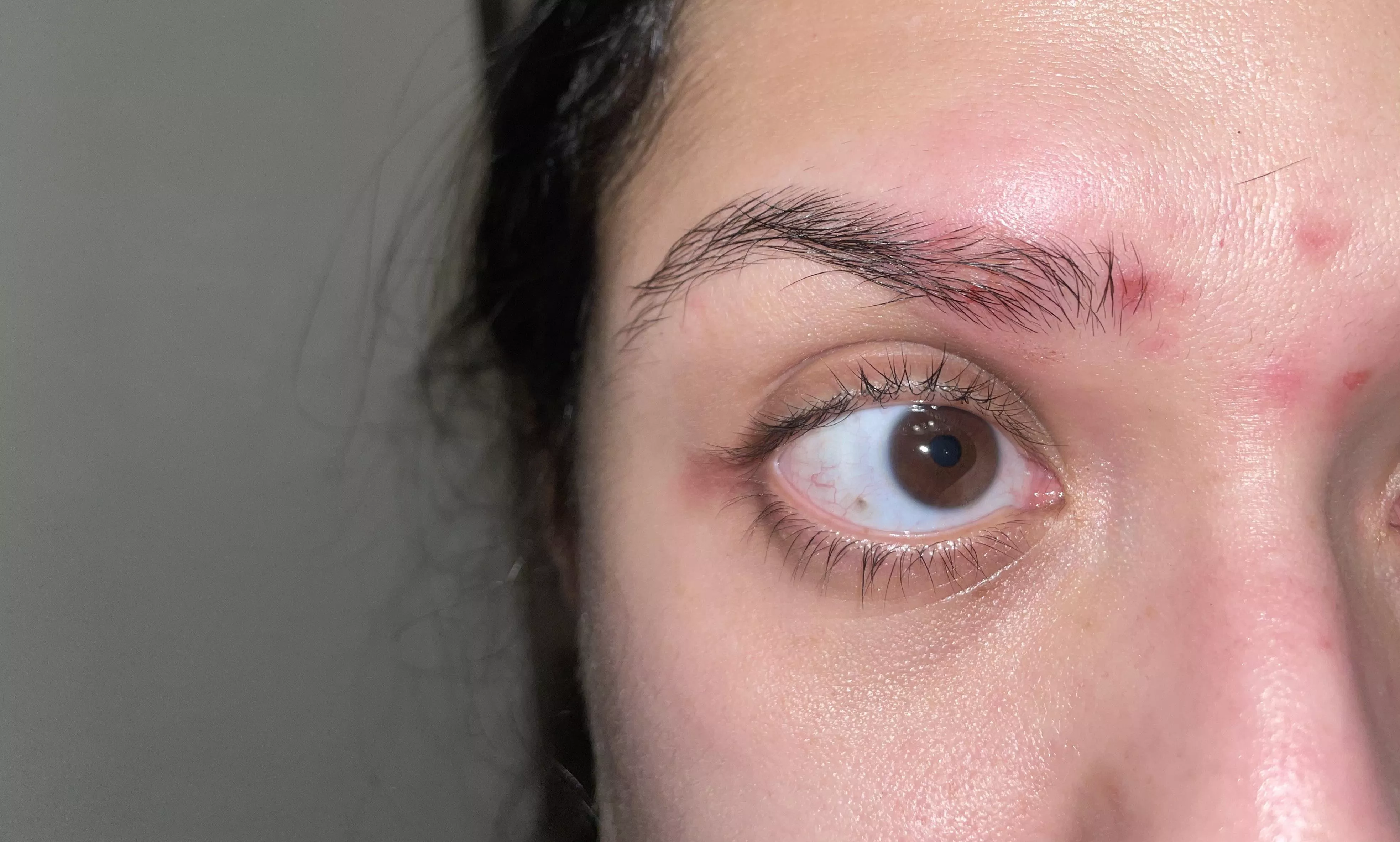 Got my eyebrows threaded Thursday. Now my eyebrow looks like this, swollen & falling out :( posted by EL-PATRON-