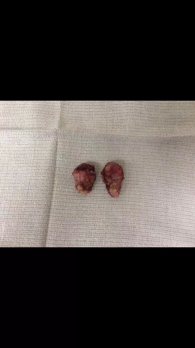 Got my tonsils taken out in 2015. Doc said when they cut into each they where full of tonsil stones. posted by Justlikepops