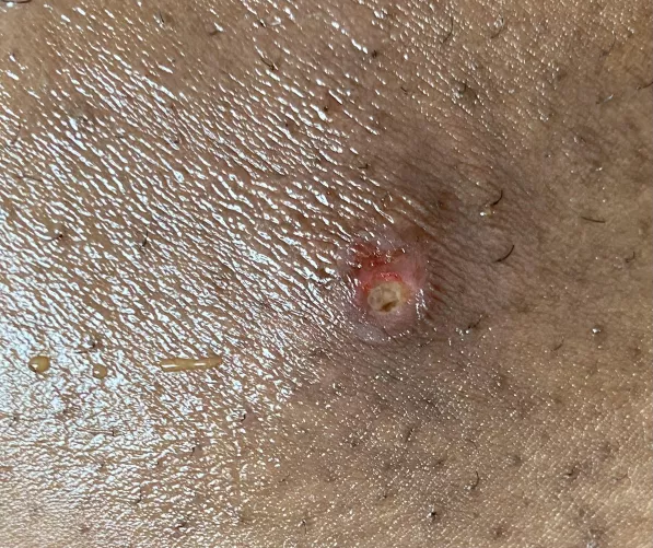 Had a somewhat large boil that popped while I was sleeping now it looks like this. Should I be worried? by despondentstudent