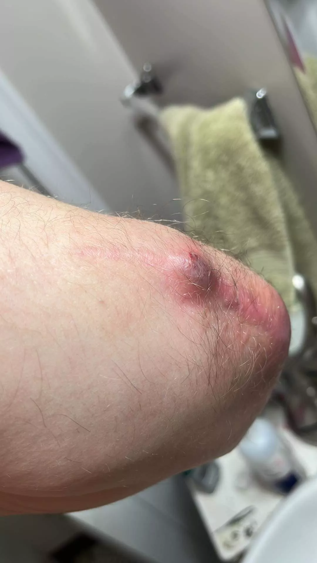 Had a surgery had an infection cleared all of that and then months later this happens. Alot of clear/red is coming out what is it what do i do posted by HolidazeForDayz