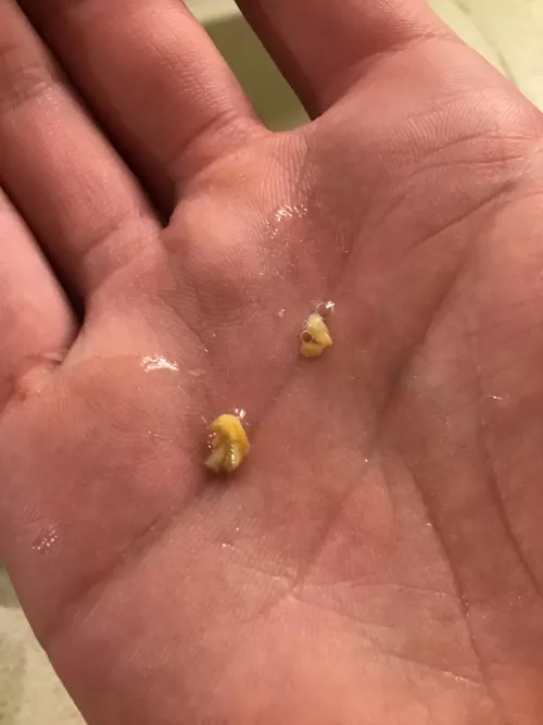Had some of what I presume to be tonsil stones that came out of my throat. I could feel them for a few days like something stuck there by No-Bother3639