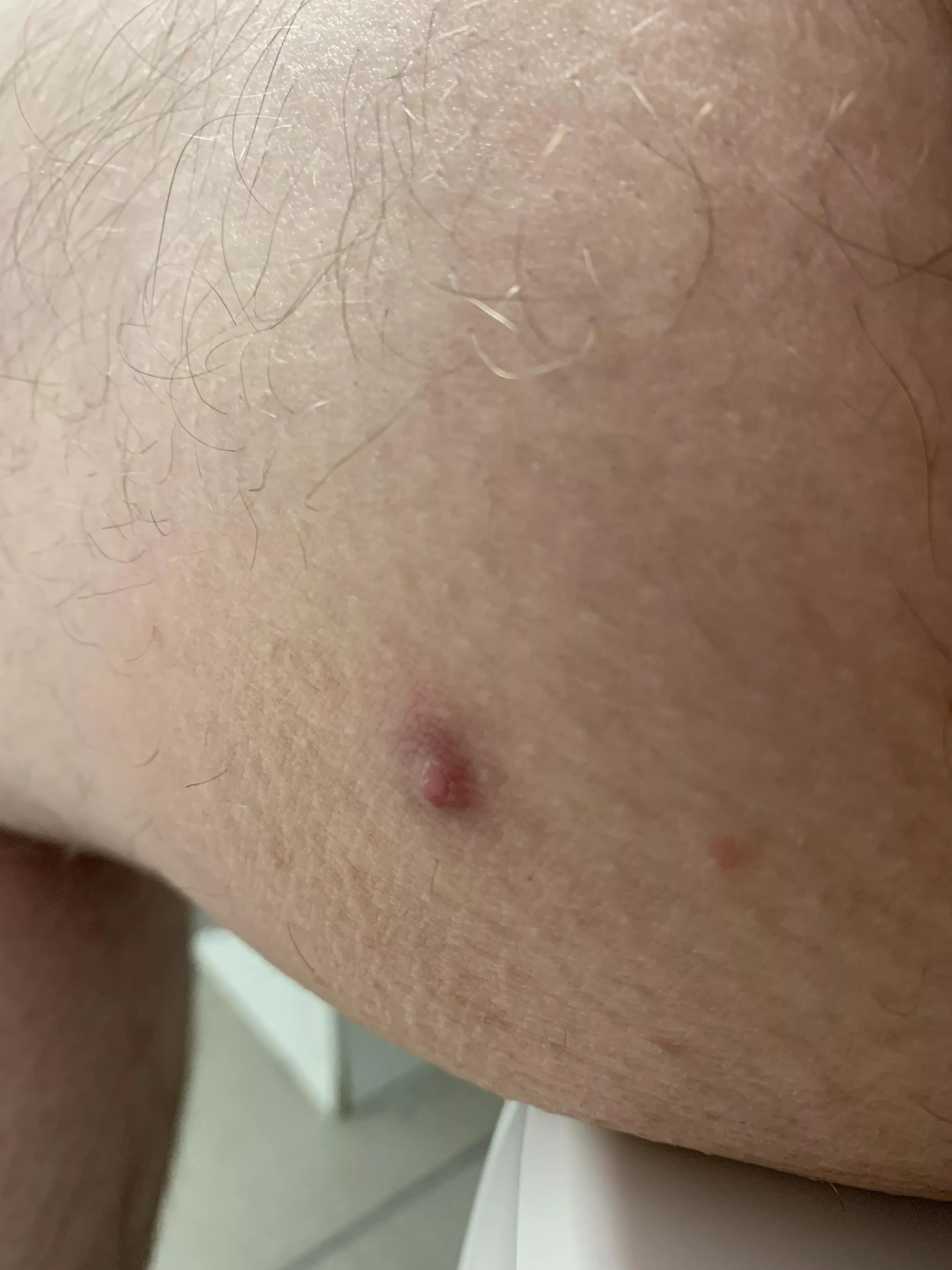 had this on my inner thigh for about two weeks now, it’s not popping and is a little sore posted by caecelius