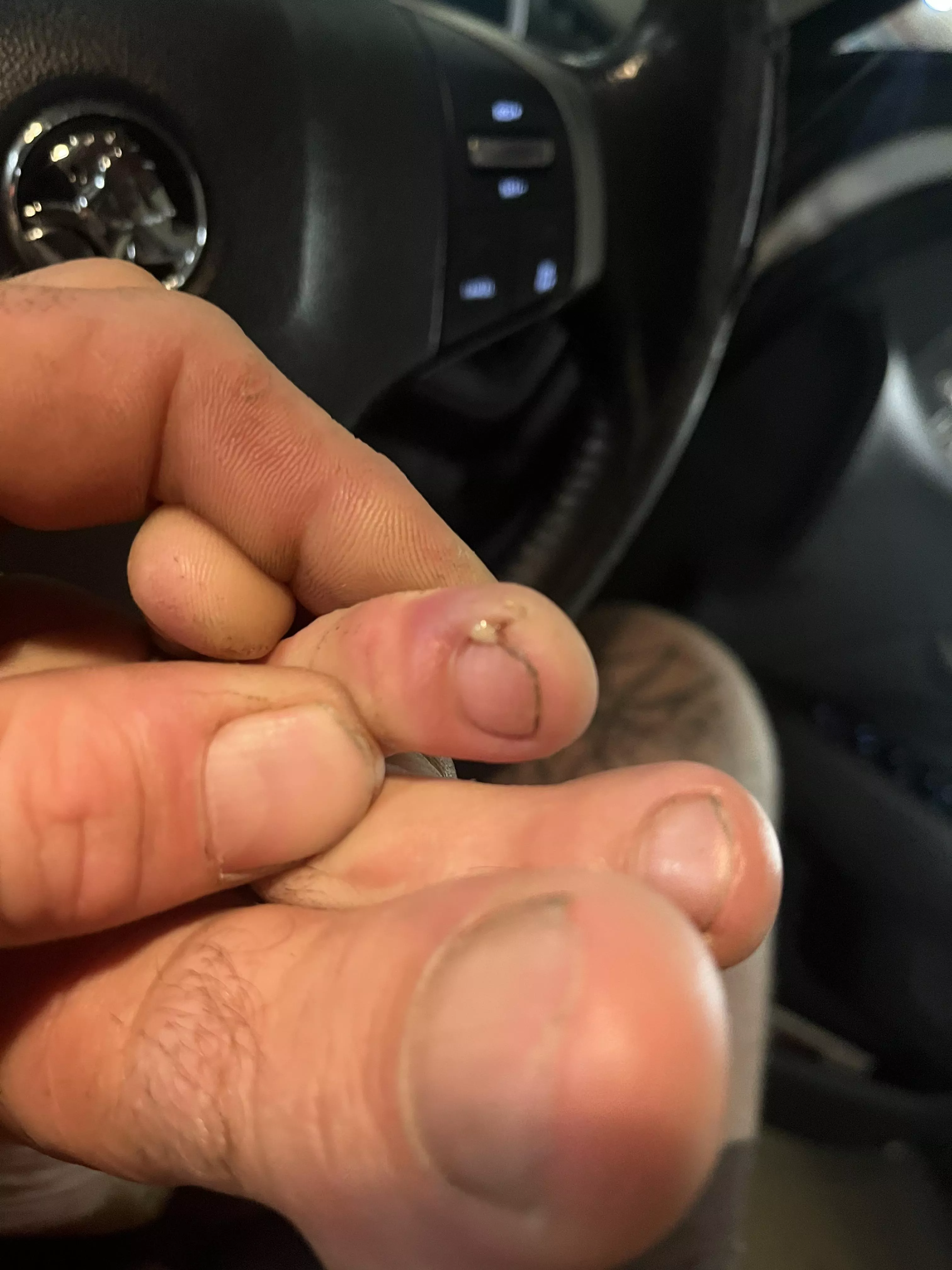 Had to deal with my home toenail surgery infection all day. Couldn’t wait to get my boot off. Yes it was wrapped and had antiseptic cream on it. Felt so good to squeeze. posted by Joe_leadbitter