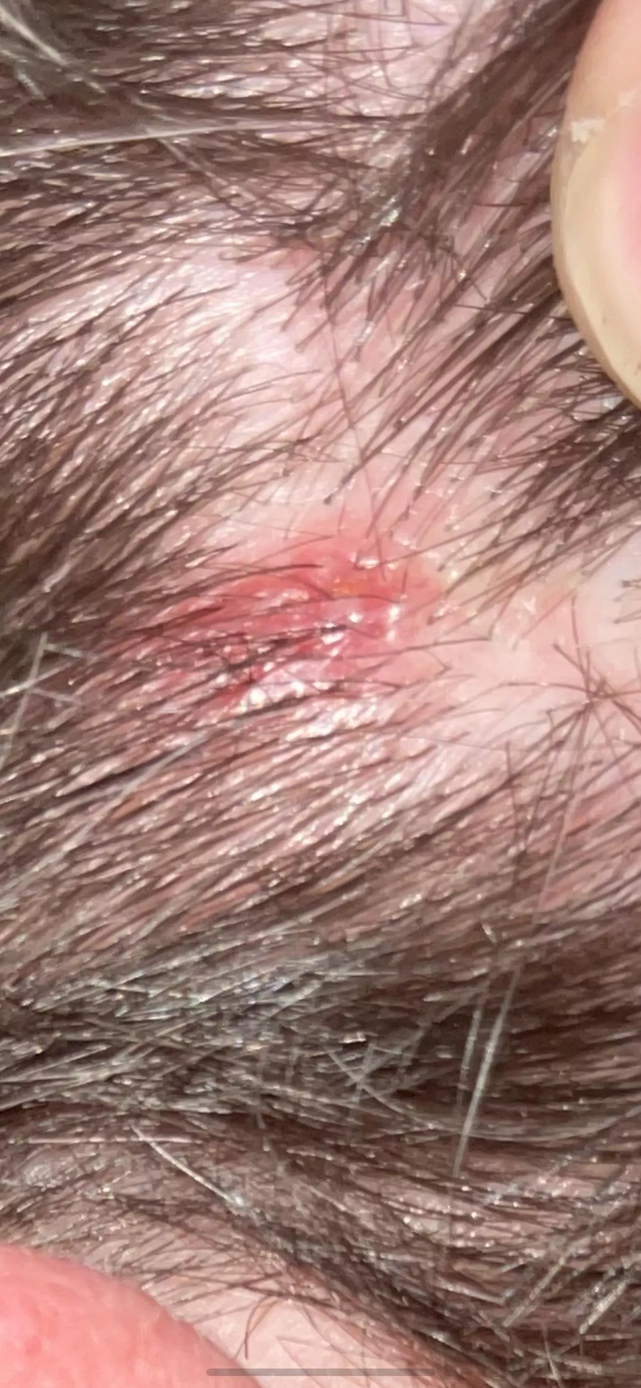 Hair line, anyone know if it’s an ingrown hair or a pimple? posted by neekodagreeko