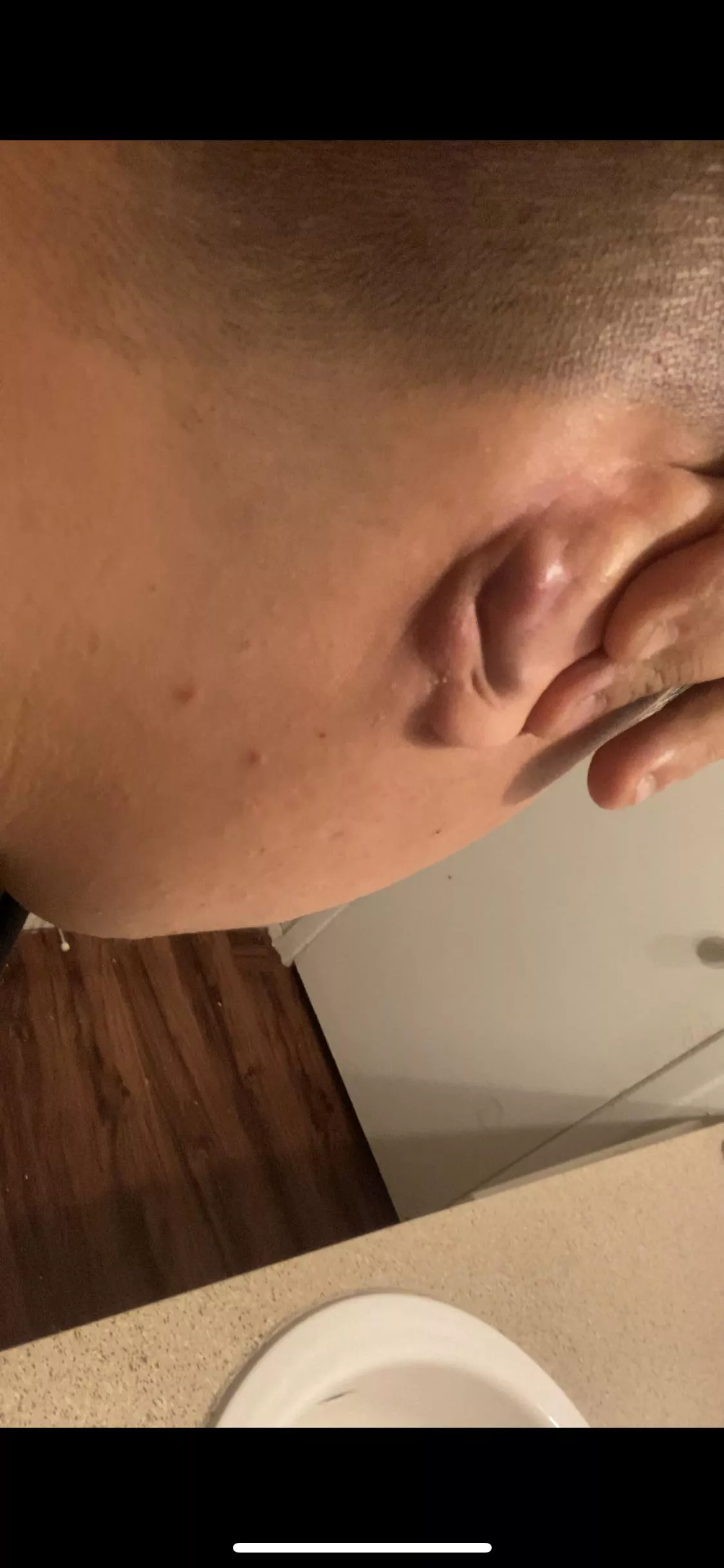 Hello should I be worried about this behind my ear I originally had a big “ cyst “ behind my ear it drain by it self an now I have two “ cyst “ posted by NetLong