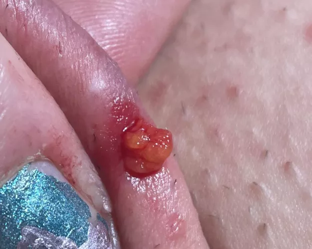 Help! What is this? After digging out an ingrown hair I started to pull this stuff out… is it a cyst? by mmlott13