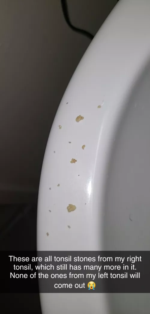 Hidden Tonsil Stones. No Satisfying Pop. So Many Left... by cdog_3-5