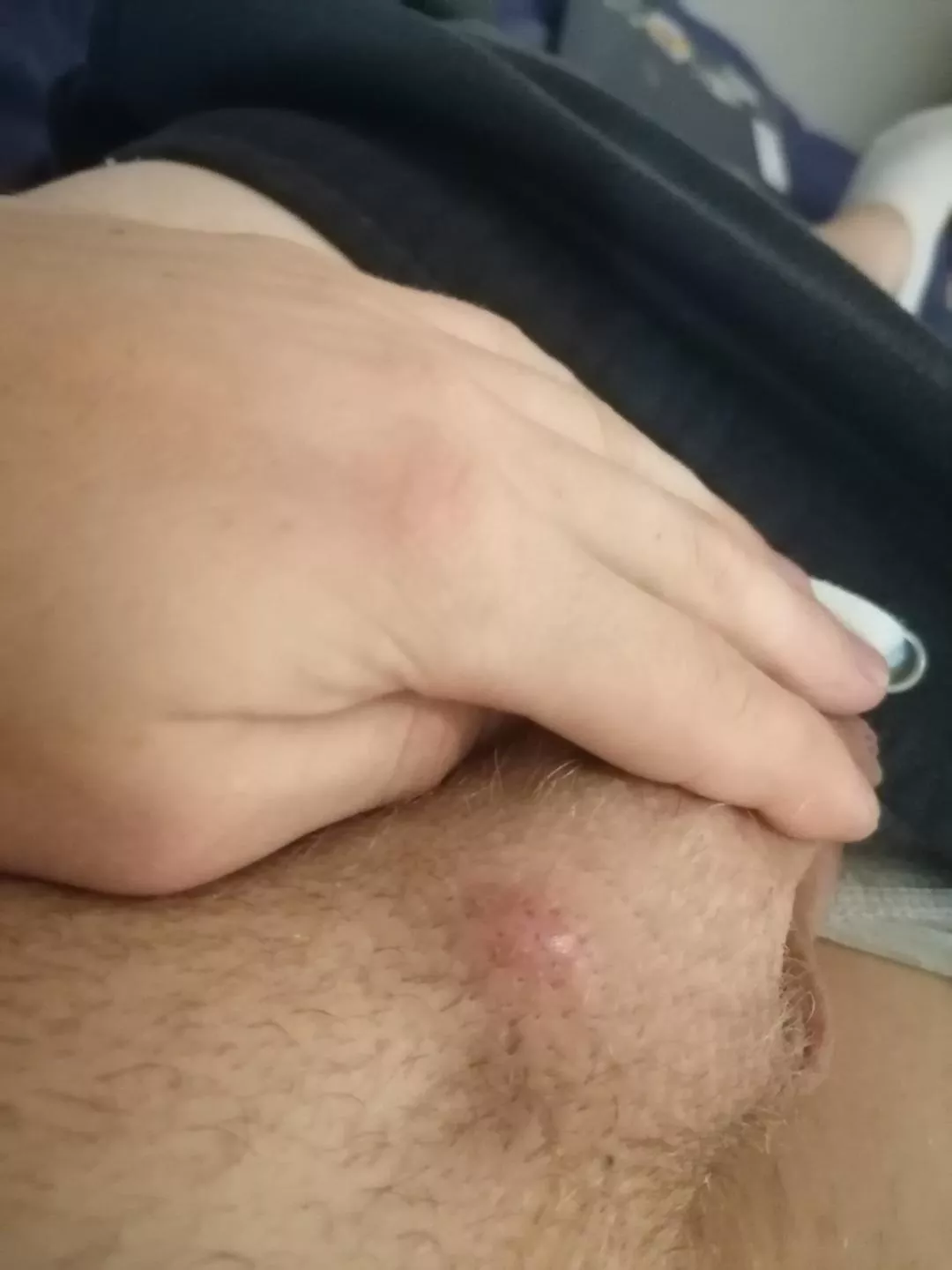 How to pop this ingrown hair? posted by D4tM4r3k