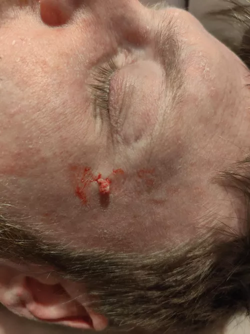 Husband has had a lump on the side of his face months and he finally let me at it with my extraction kit. This is only a tiny fraction of what came out, I wish I'd set the camera up to video! by lilzabob123