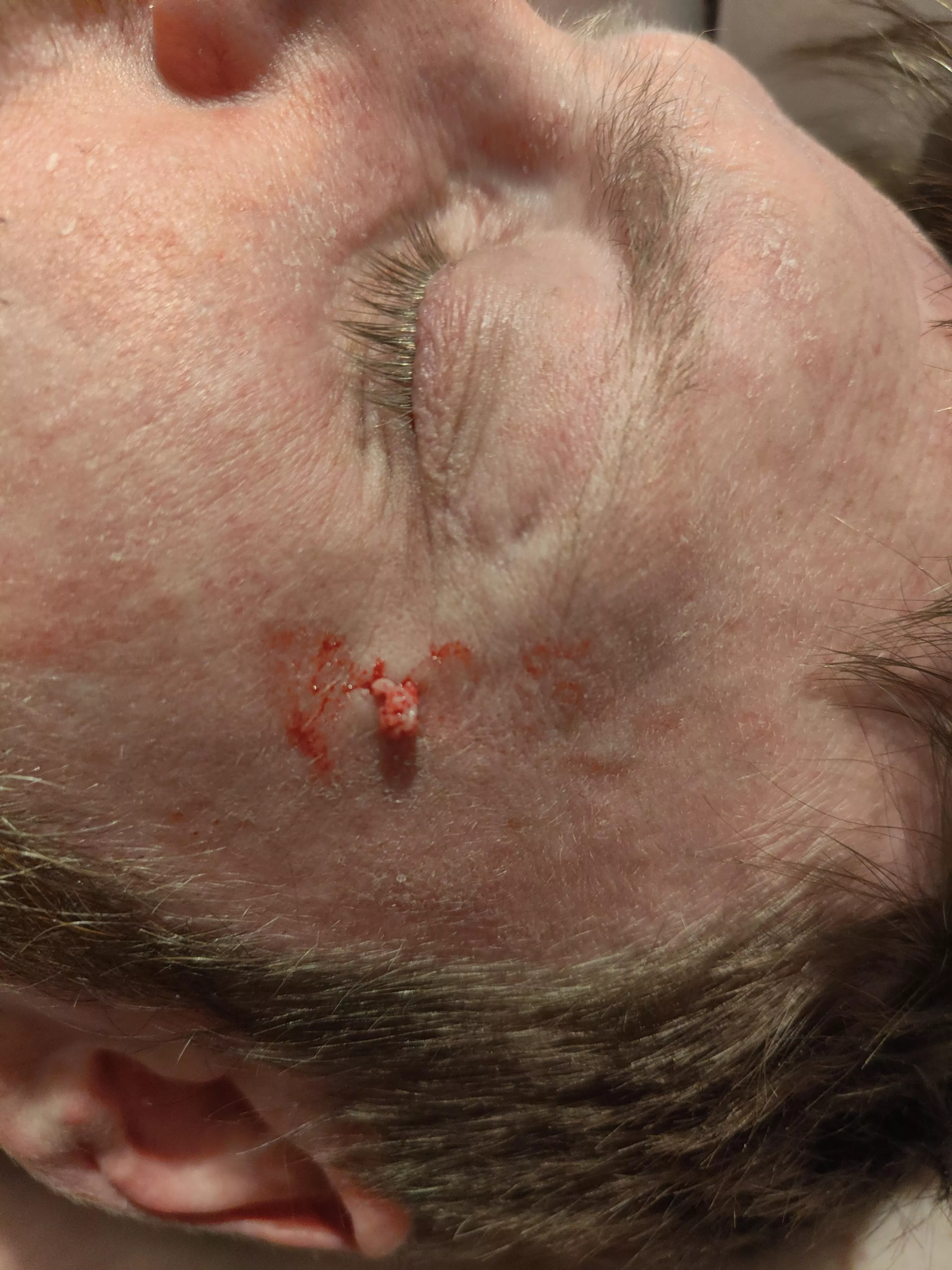 Husband has had a lump on the side of his face months and he finally let me at it with my extraction kit. This is only a tiny fraction of what came out, I wish I'd set the camera up to video! posted by lilzabob123