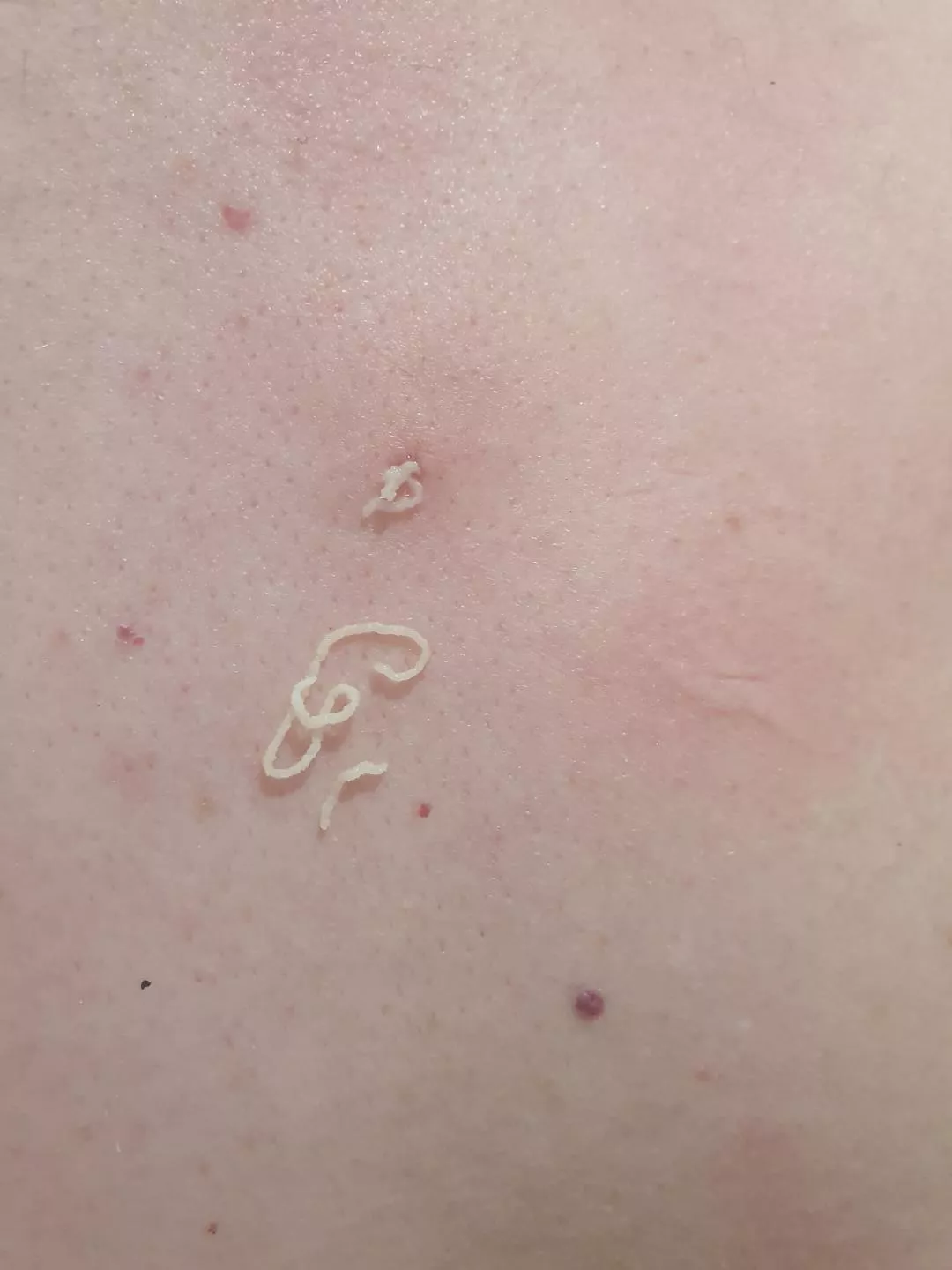 Husband's cyst refilled, what a treat posted by sazazzles