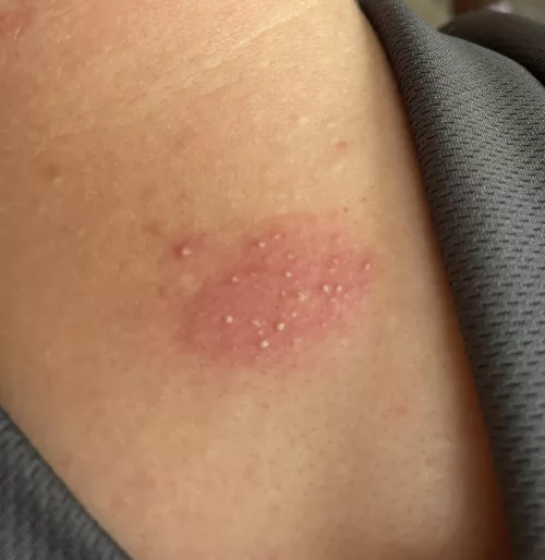 I don’t know what caused this. Bug bite? Want to pop. by Caroldactyl1204
