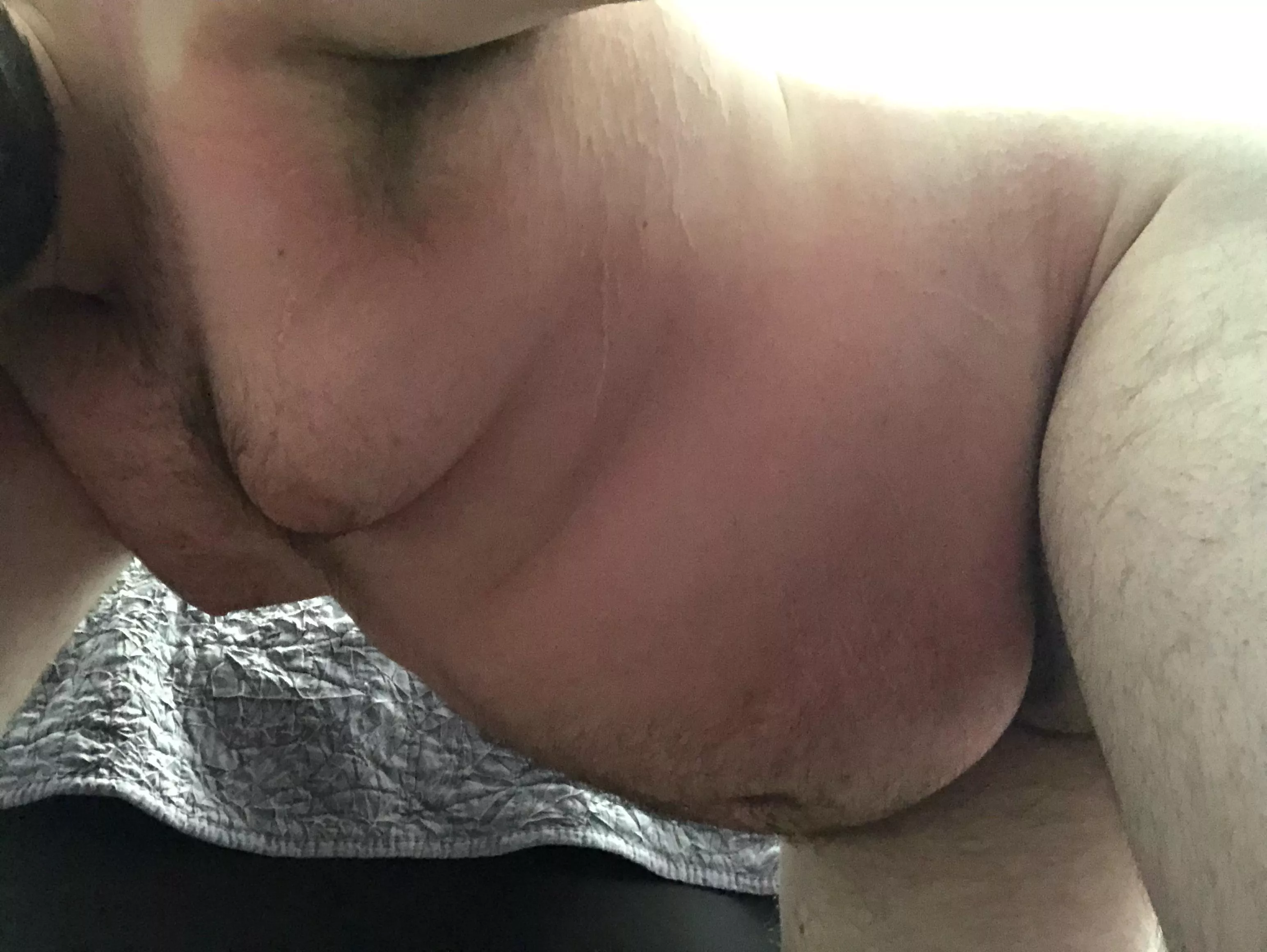 I got so burnt I look like a real piggy 🐷 posted by BigJigglyFatty