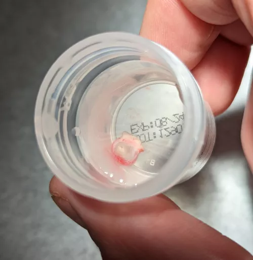 I had a cyst removed from my upper back. Doctor was able to remove it all without rupturing the sac by romulan267