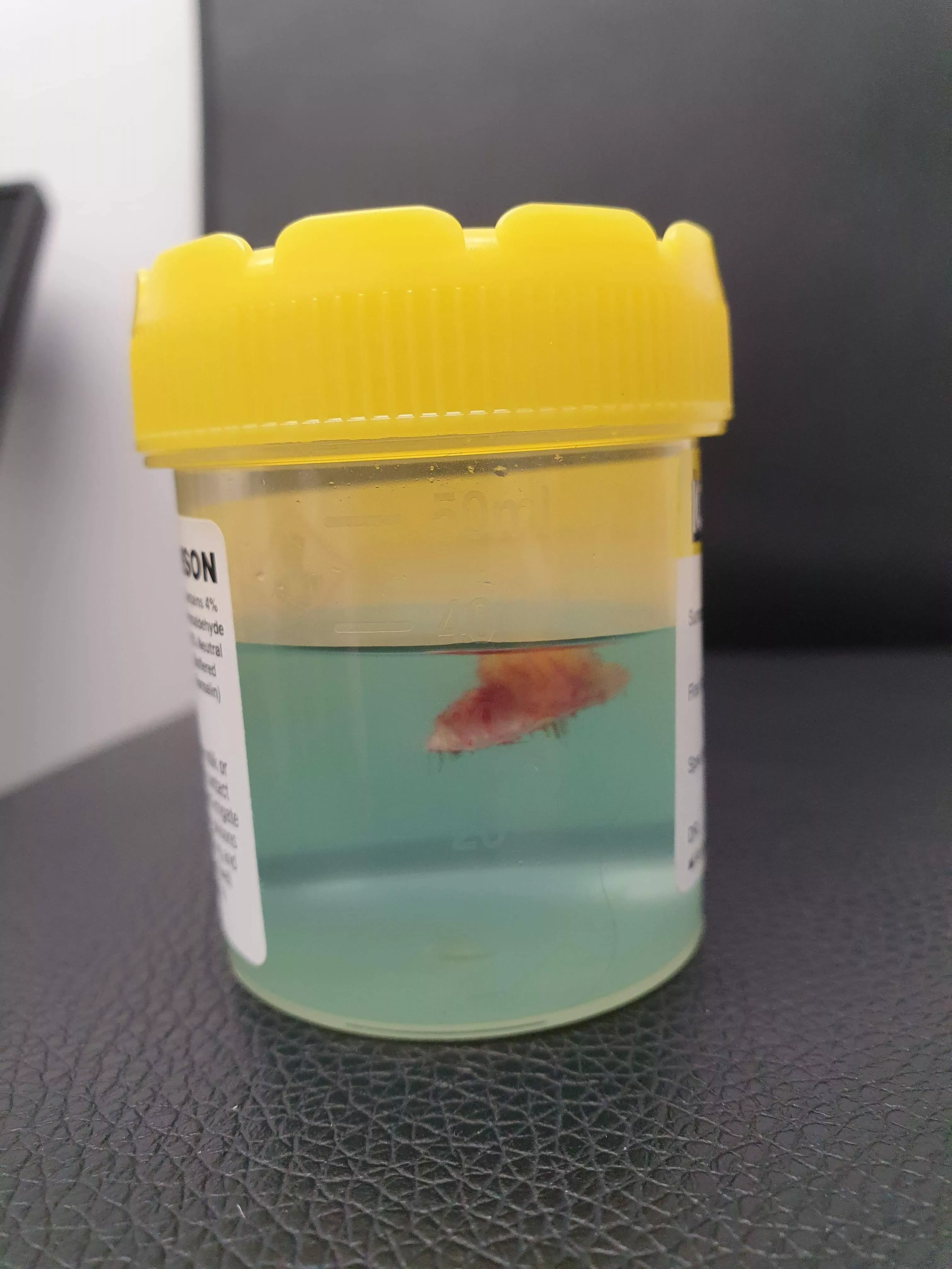 I had a sebaceous cyst cut out of my scalp yesterday. posted by ToughProfile5189