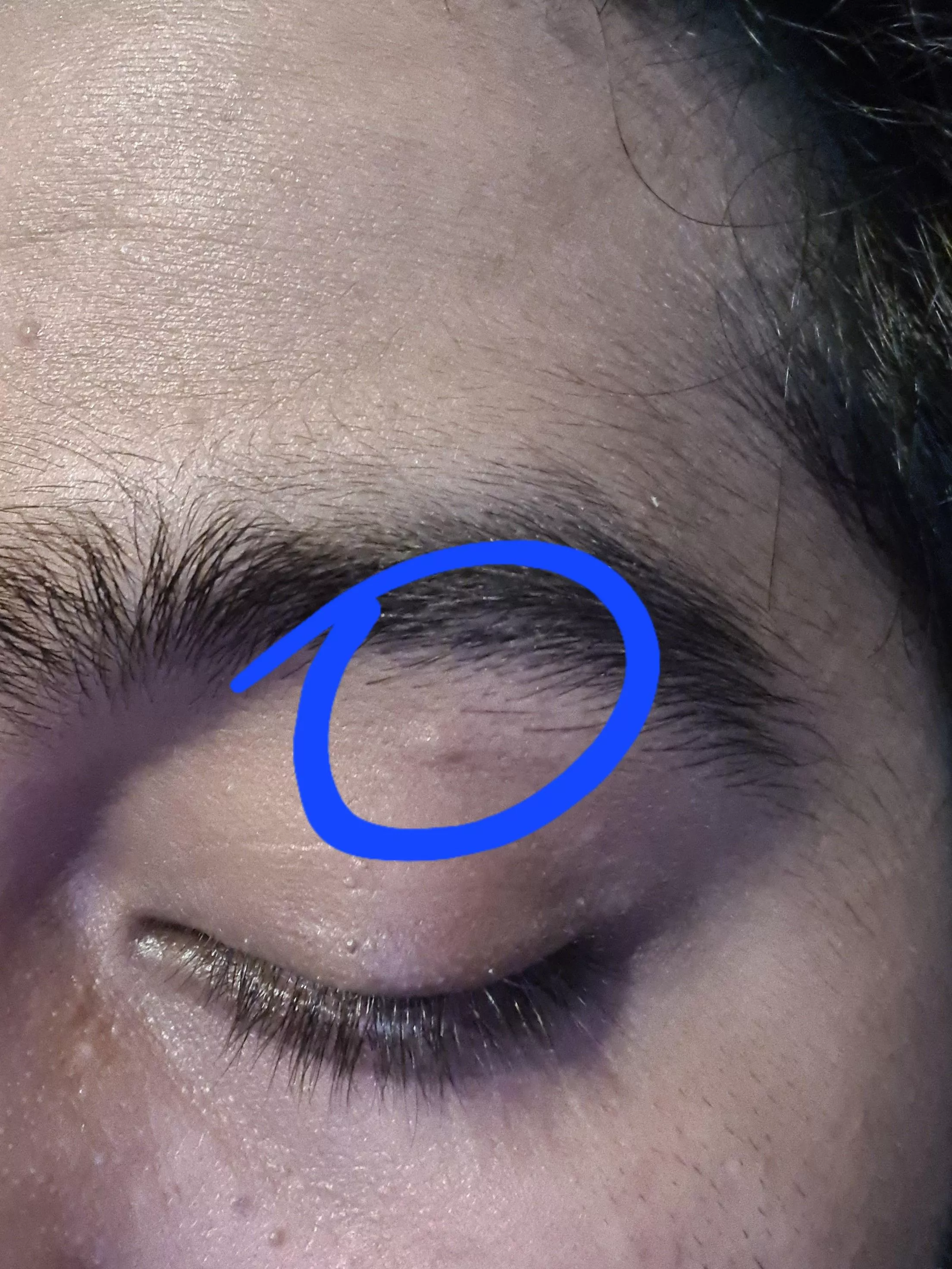 I have this bump like thing above my eye lid since yesterday. Is this normal or should I get it checked up? posted by deepanshu_2893
