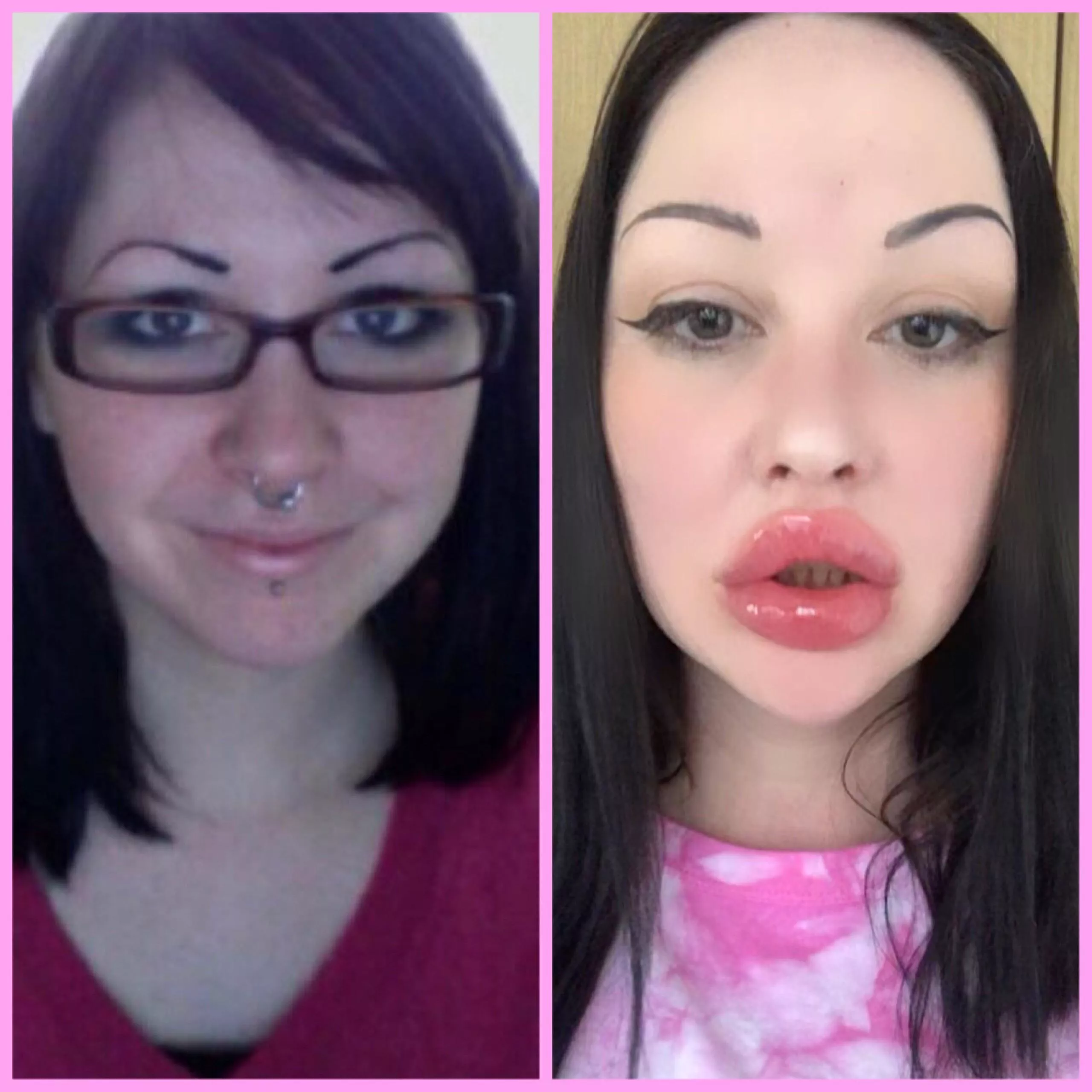 I just can’t stop bimbofying my face 💉💋💖 posted by laylabimbo