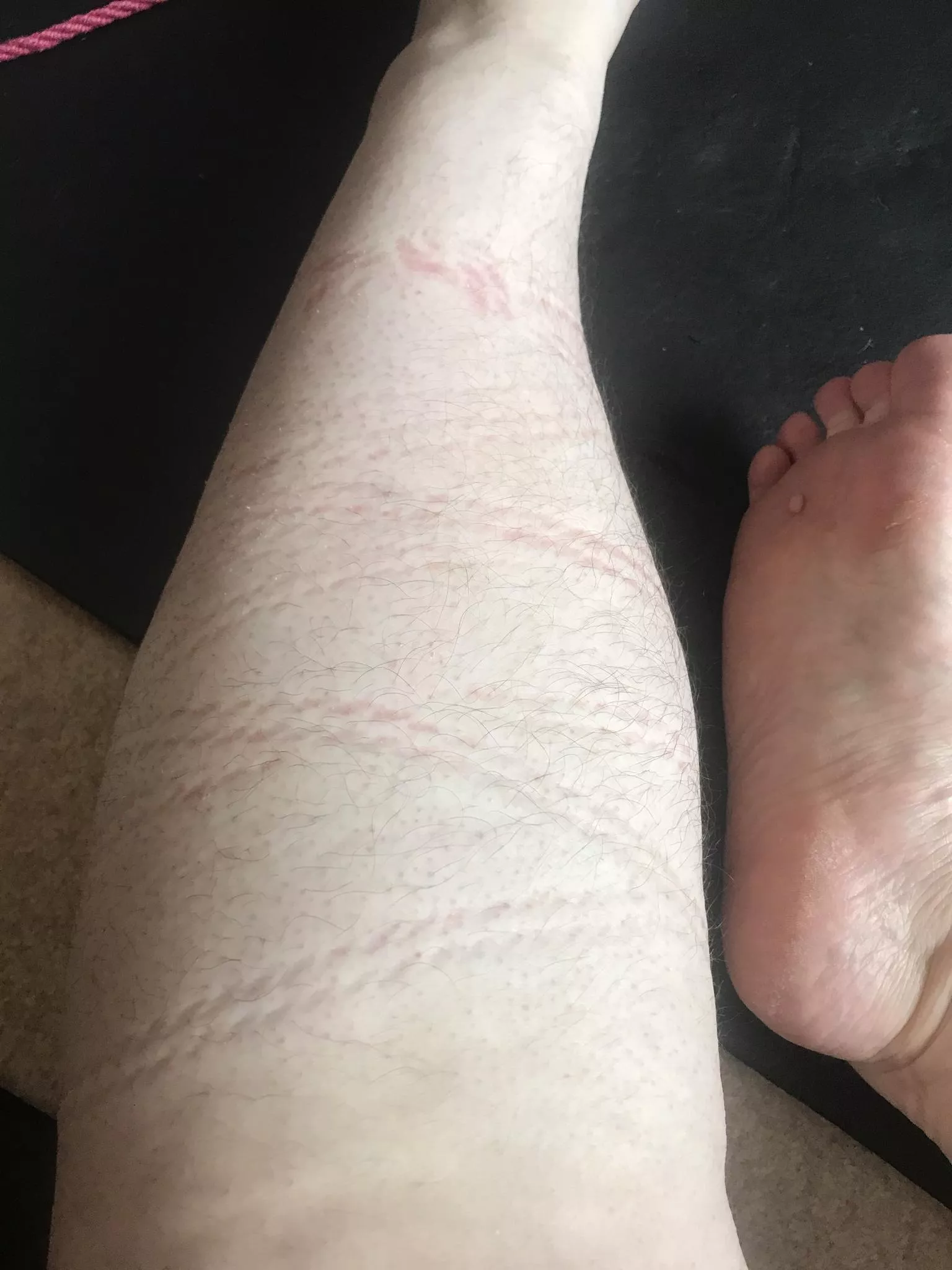 I love the rope marks after I've been tied! posted by NimueAllen