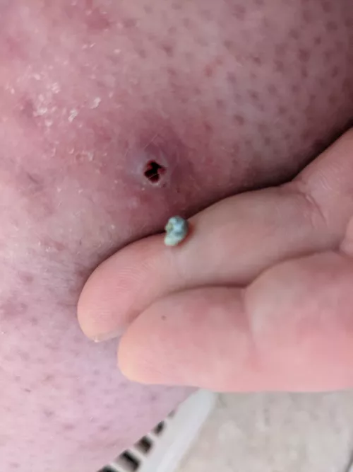 I Tweezed Something From my Leg! by someBrokeCanadian