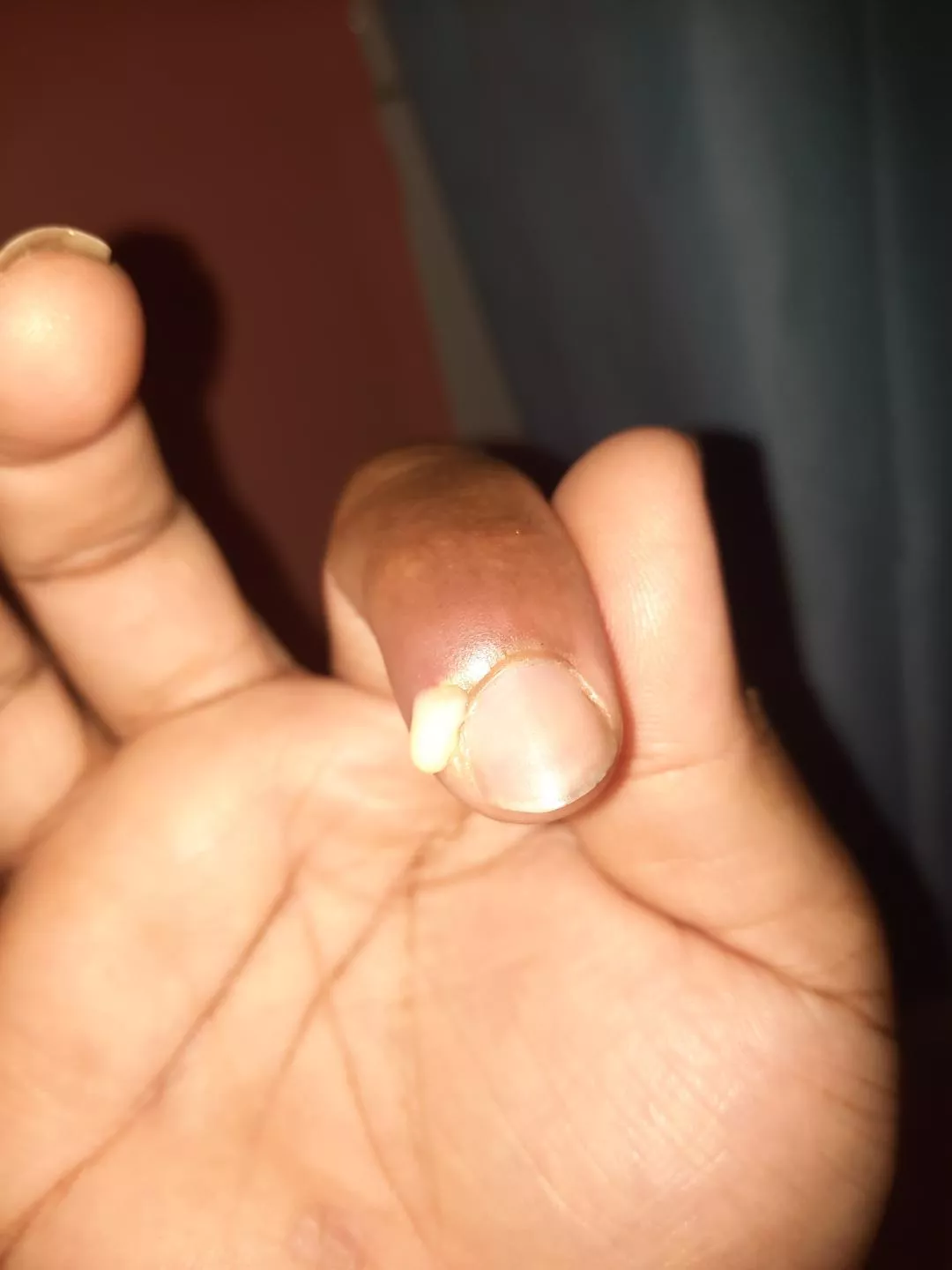 Infected finger. It smelled like rotten glue. posted by Super_Significance8