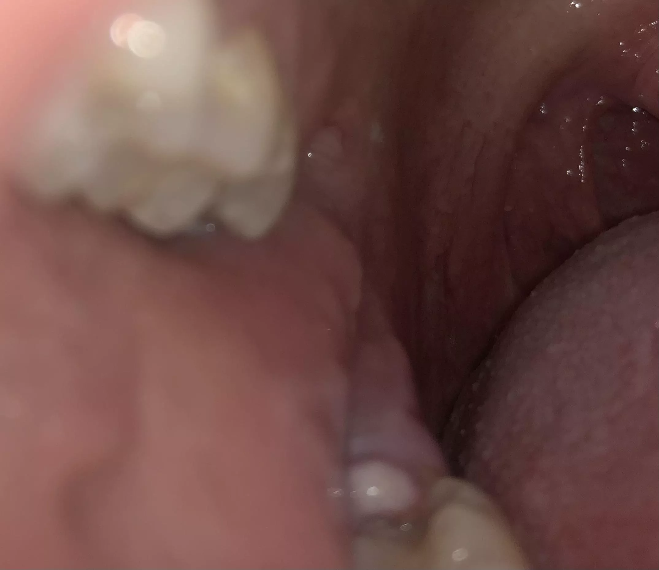 Infected operculum - pericoronitis. An infected flap of gums that falls across the molar. It hurts like hell. On antibiotics. I apologize for nothing. posted by _chaseh_